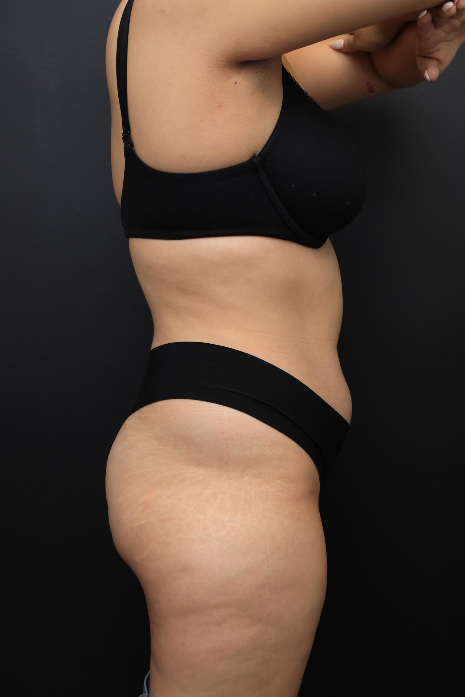 Right Lateral Before