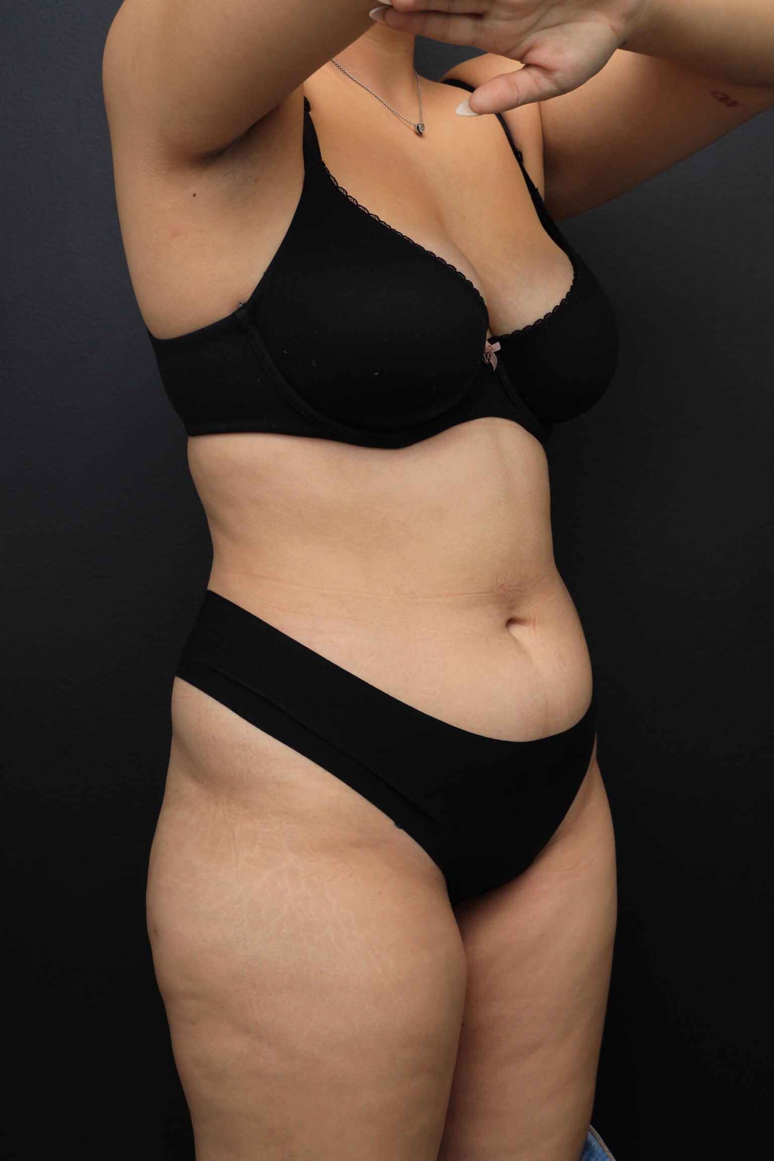 Right Oblique Before