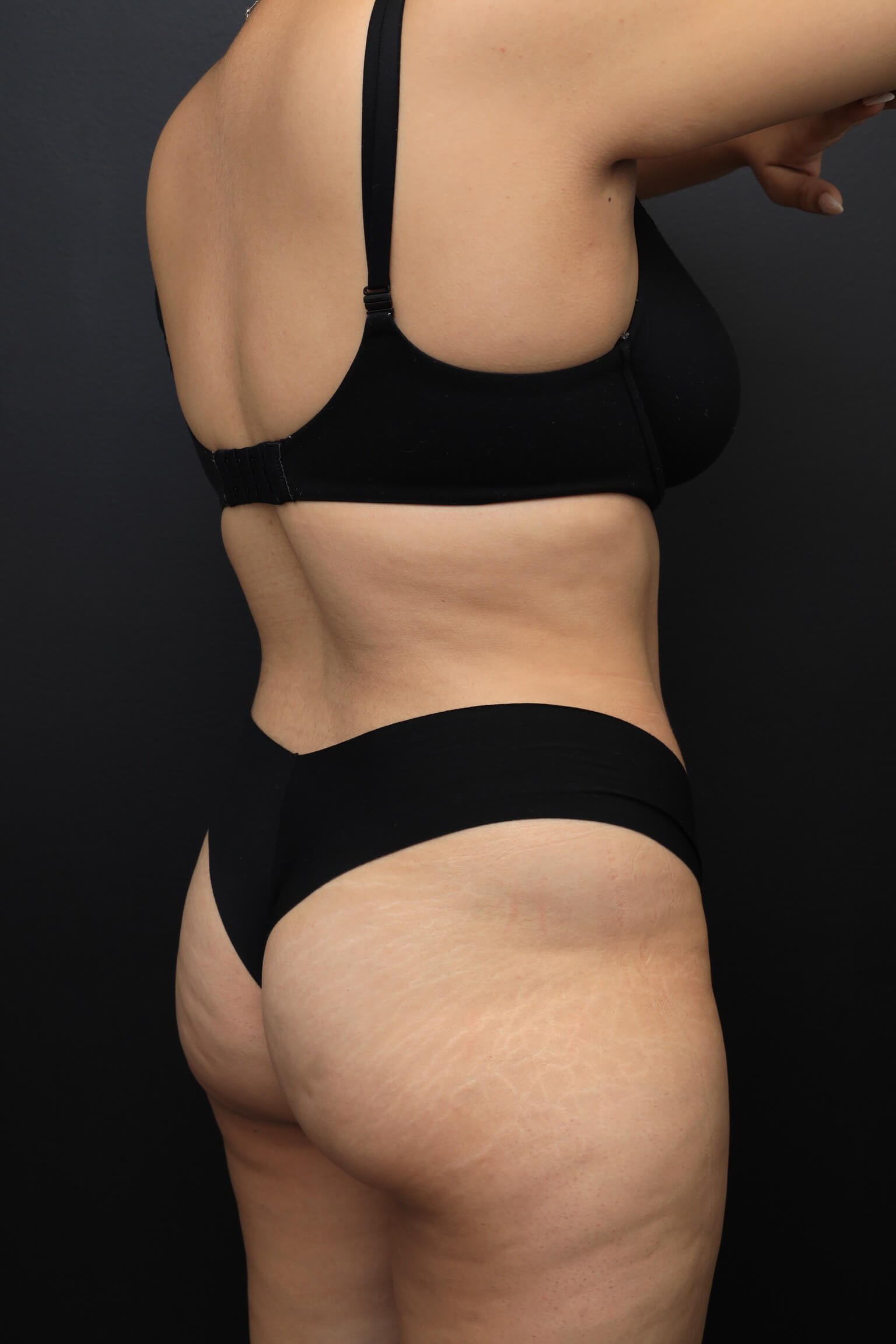 Right Posterior Oblique Before