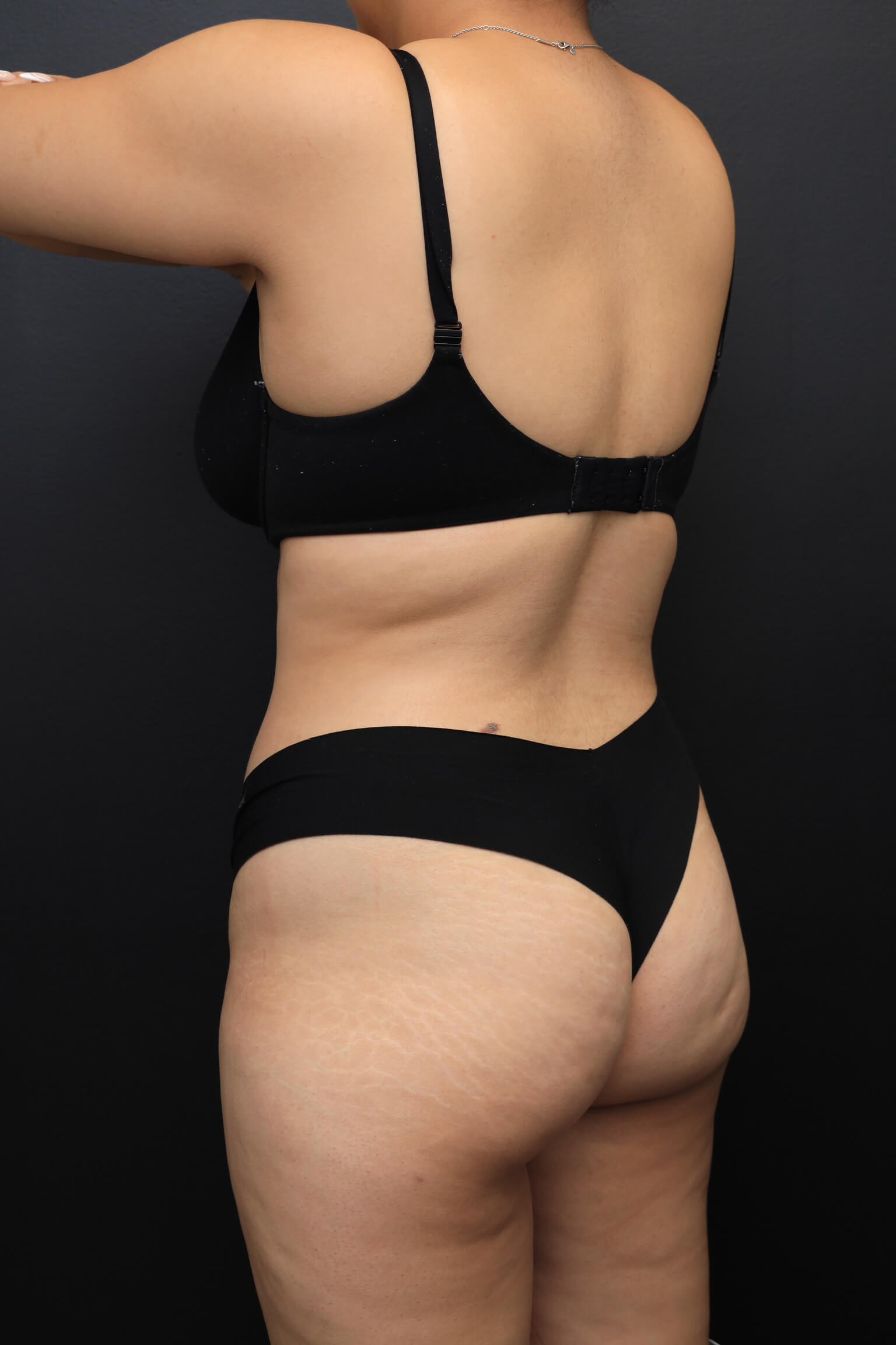 Left Posterior Oblique Before