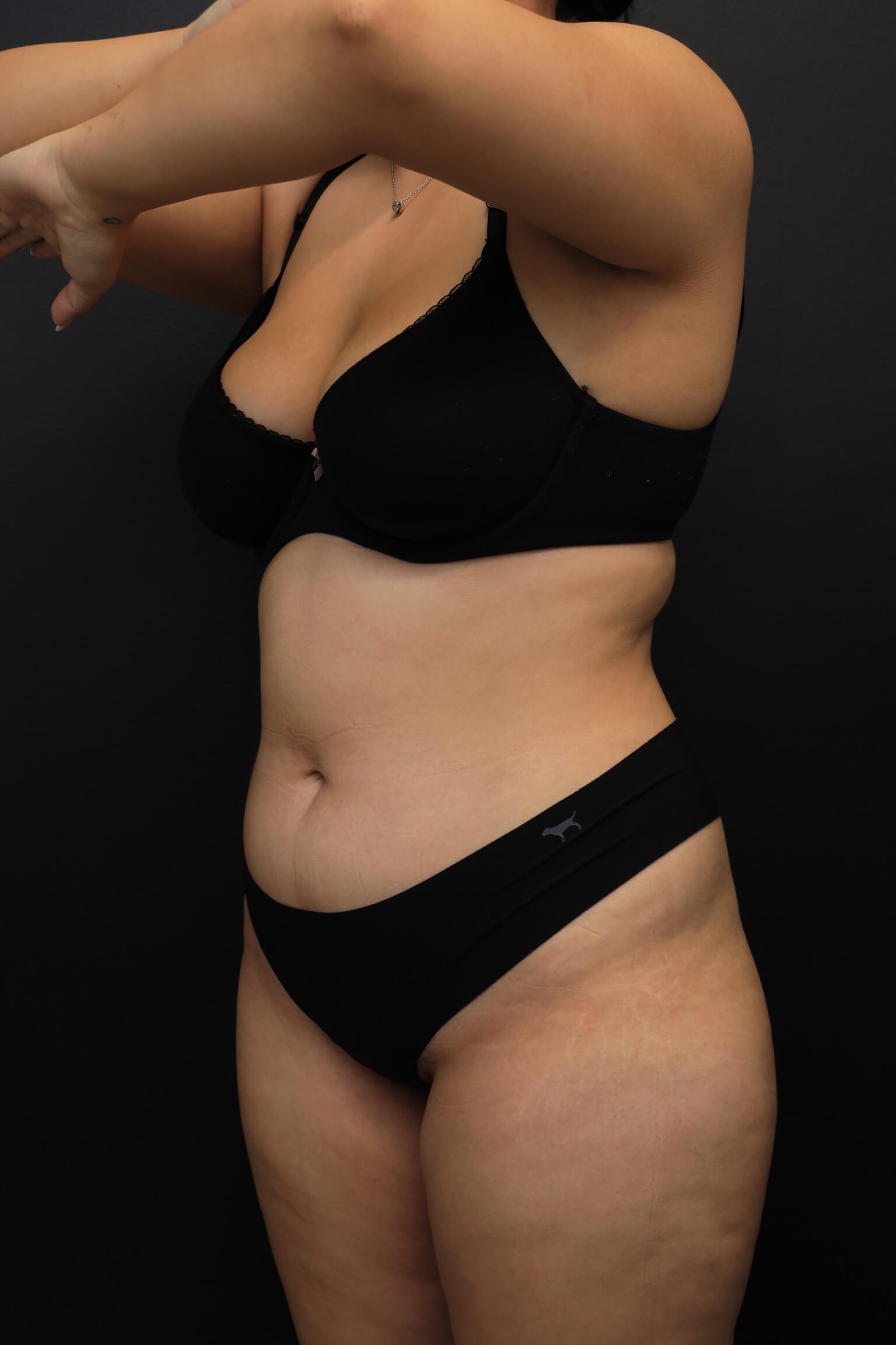 Left Oblique Before