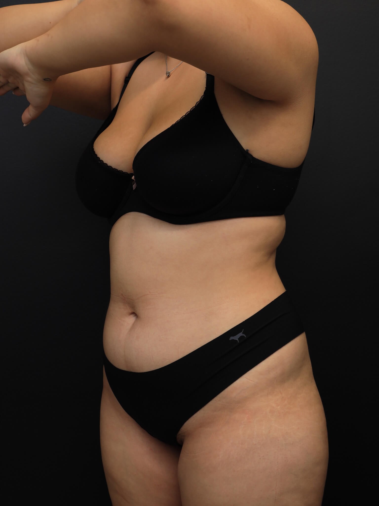 Left Oblique Before