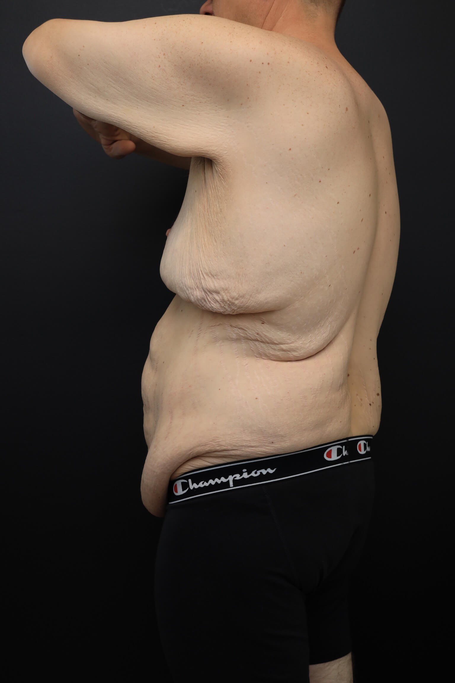 Left Posterior Oblique Before