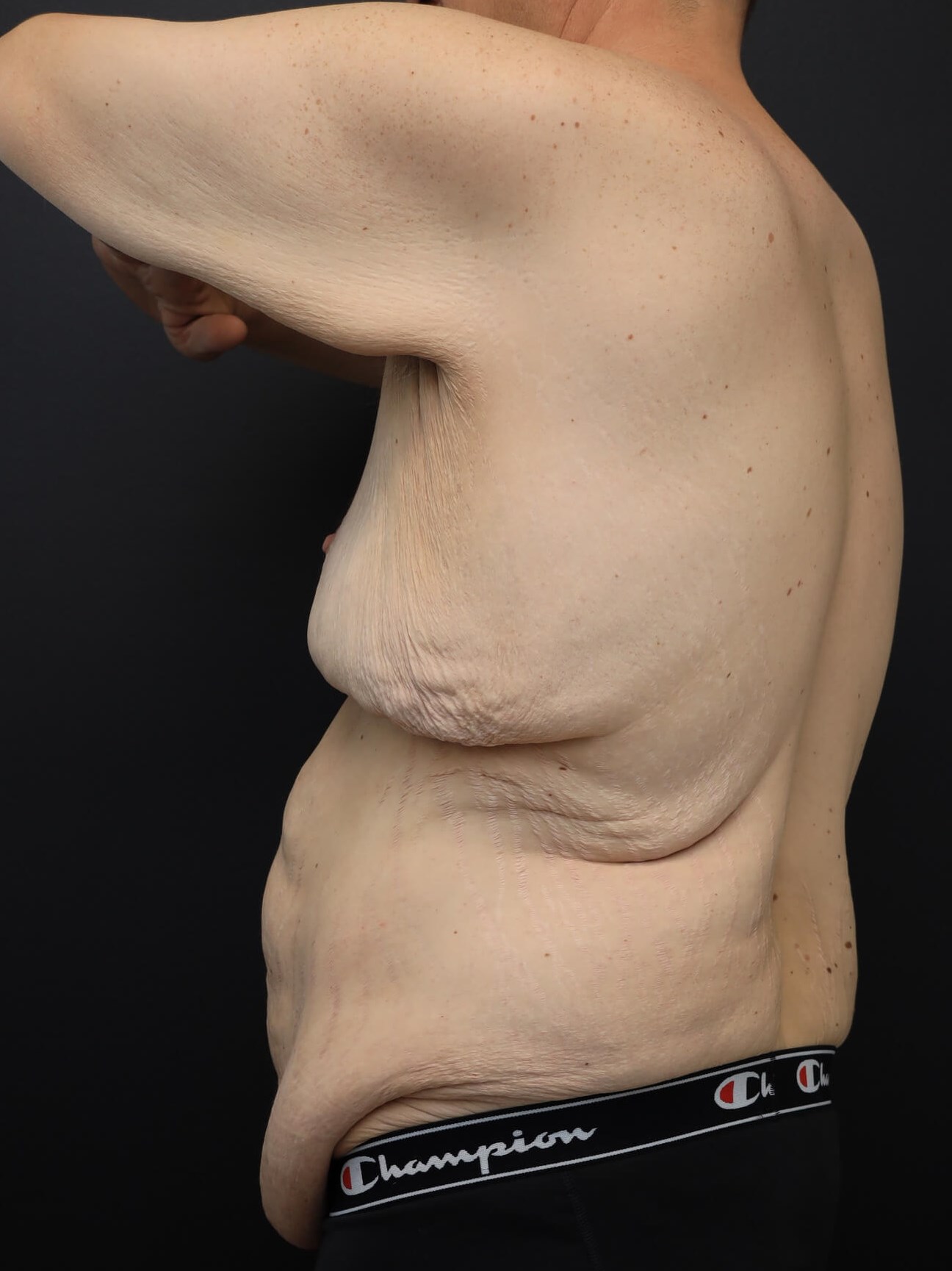 Left Posterior Oblique Before