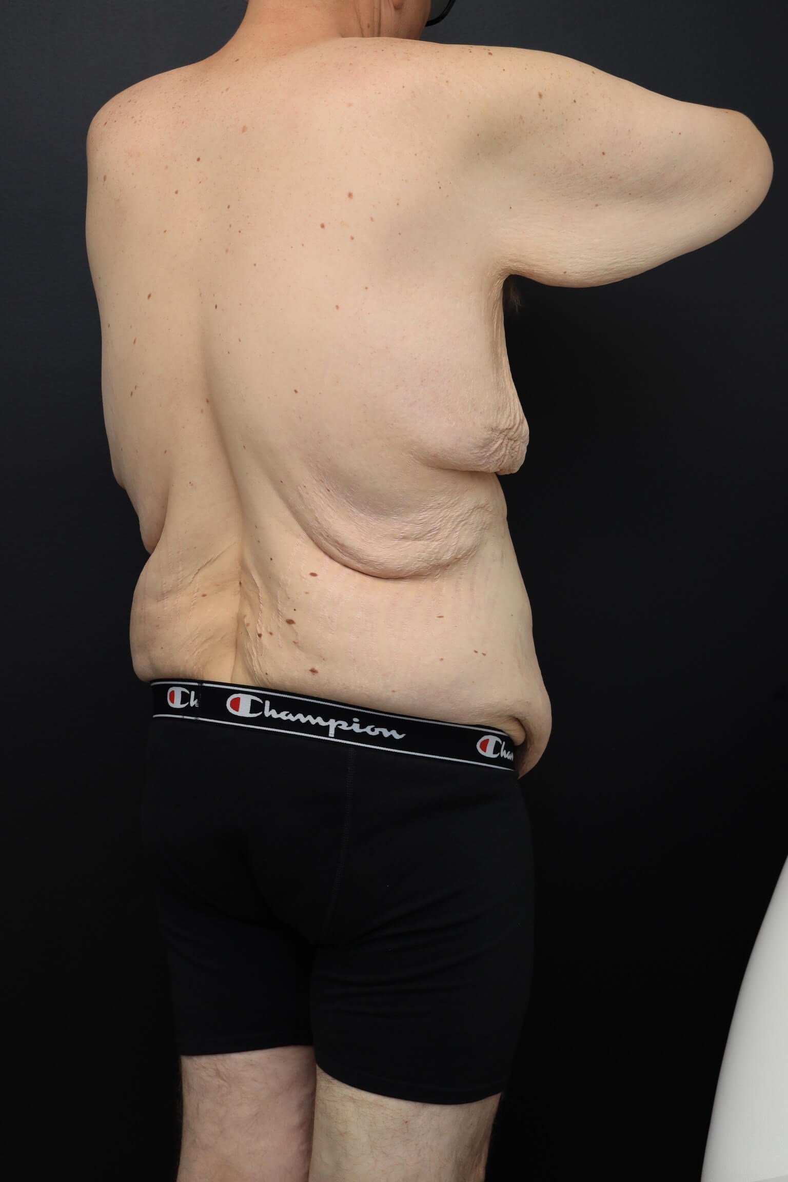 Right Posterior Oblique Before