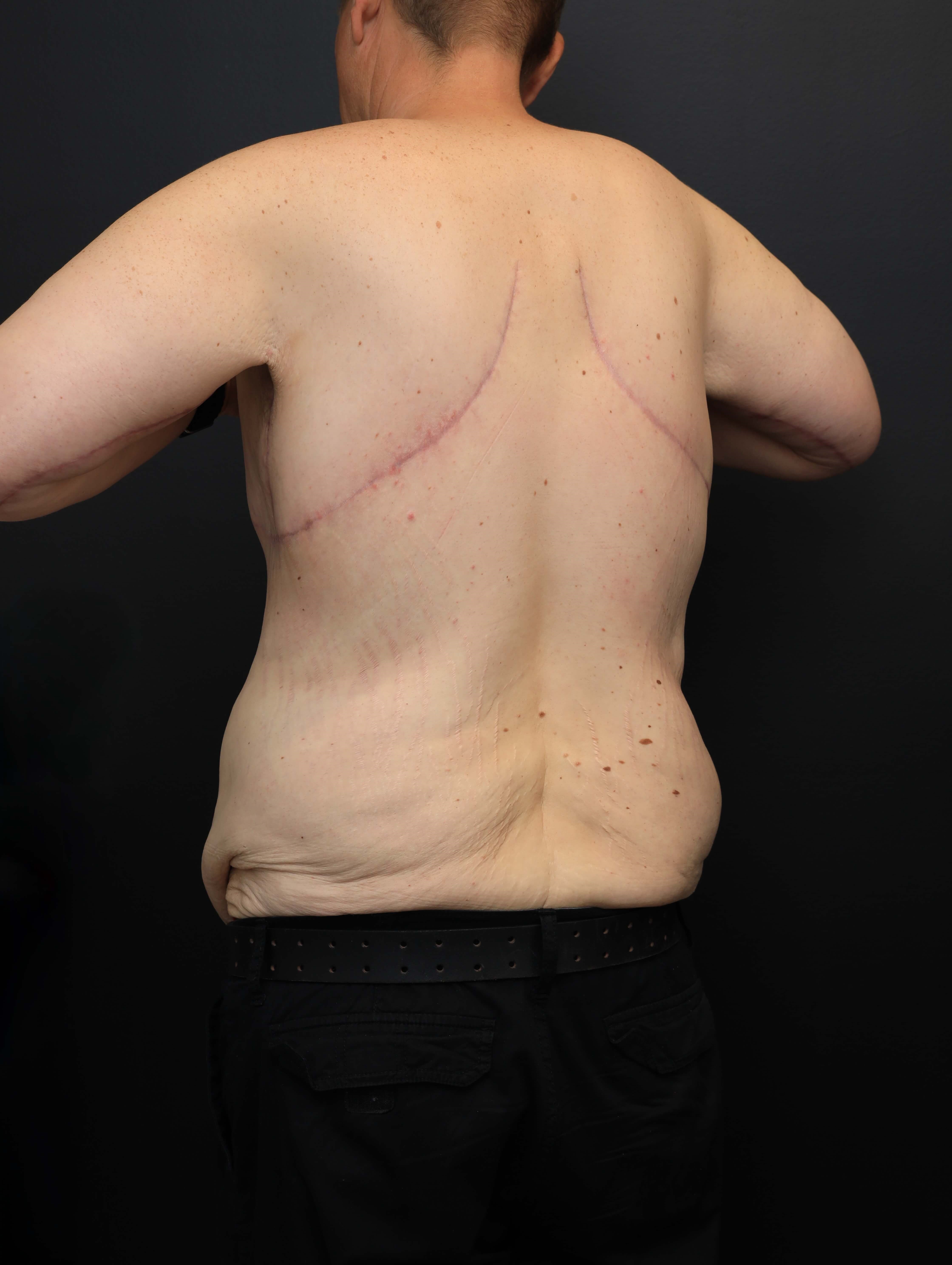Left Posterior Oblique After