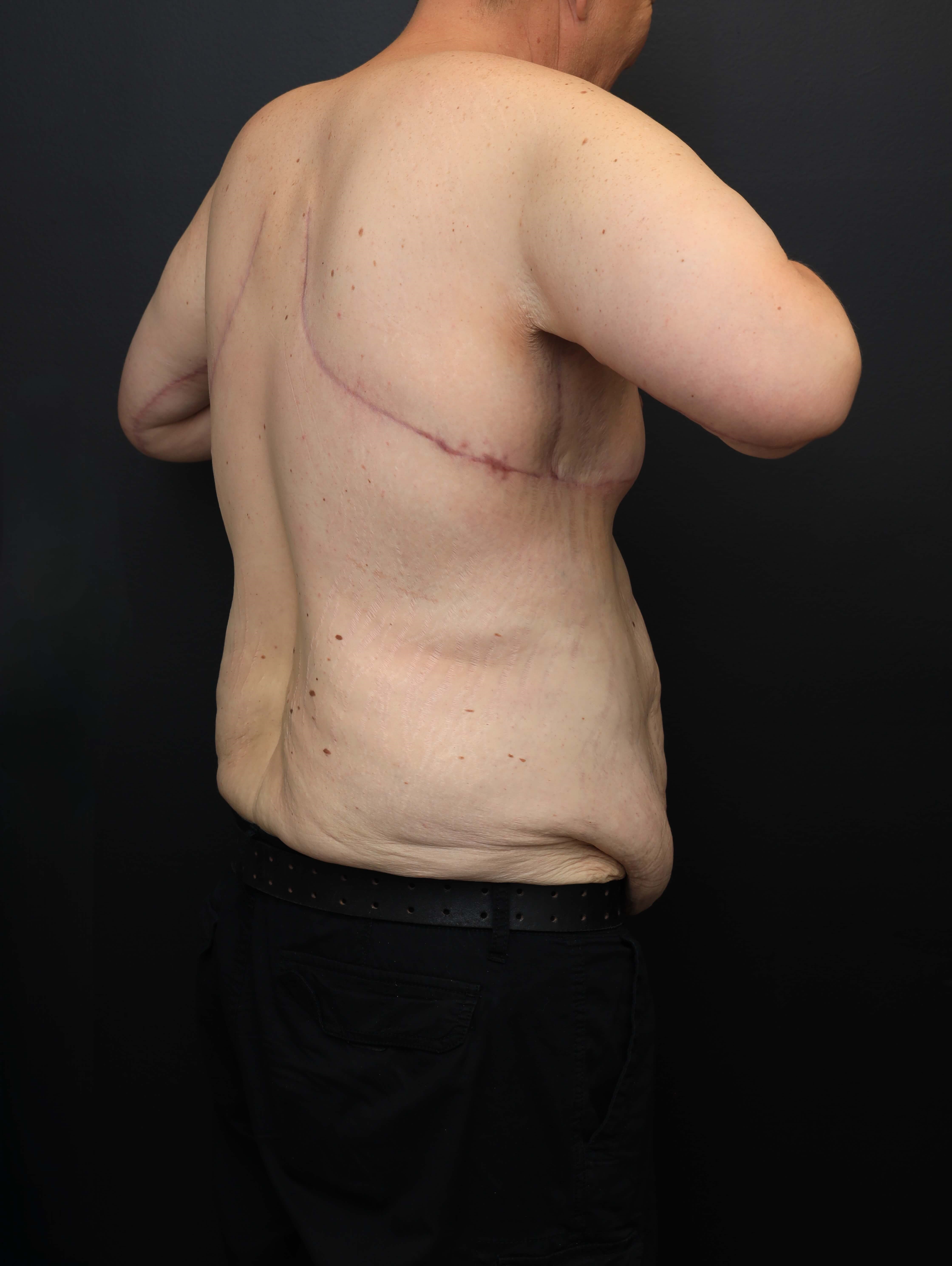 Right Posterior Oblique After