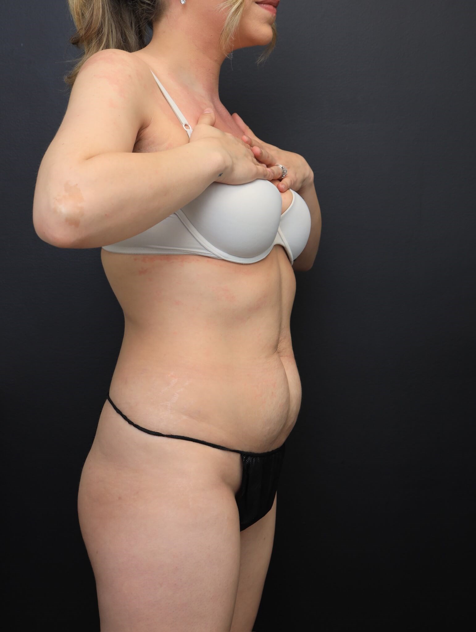 Right Oblique Before