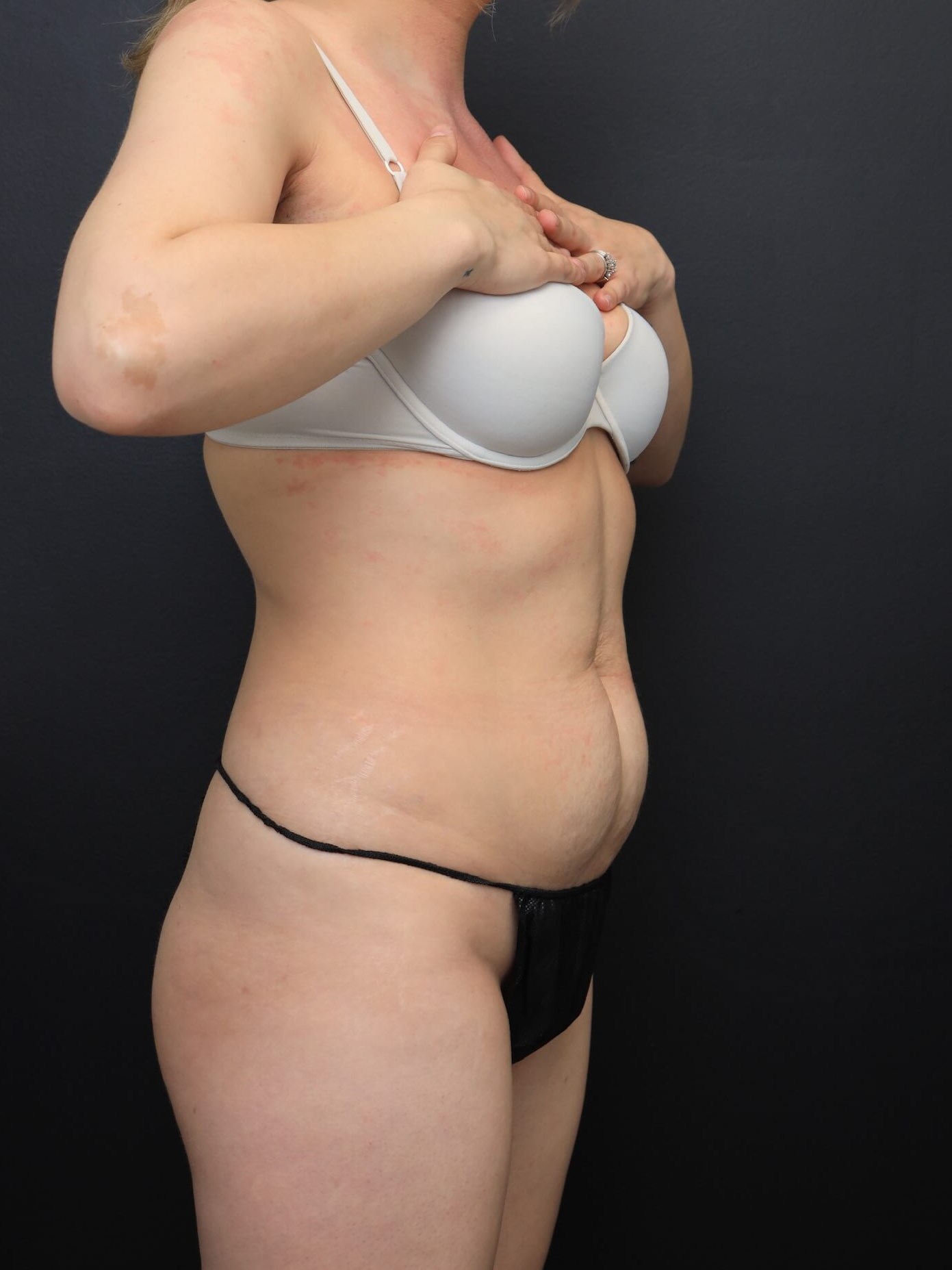 Right Oblique Before
