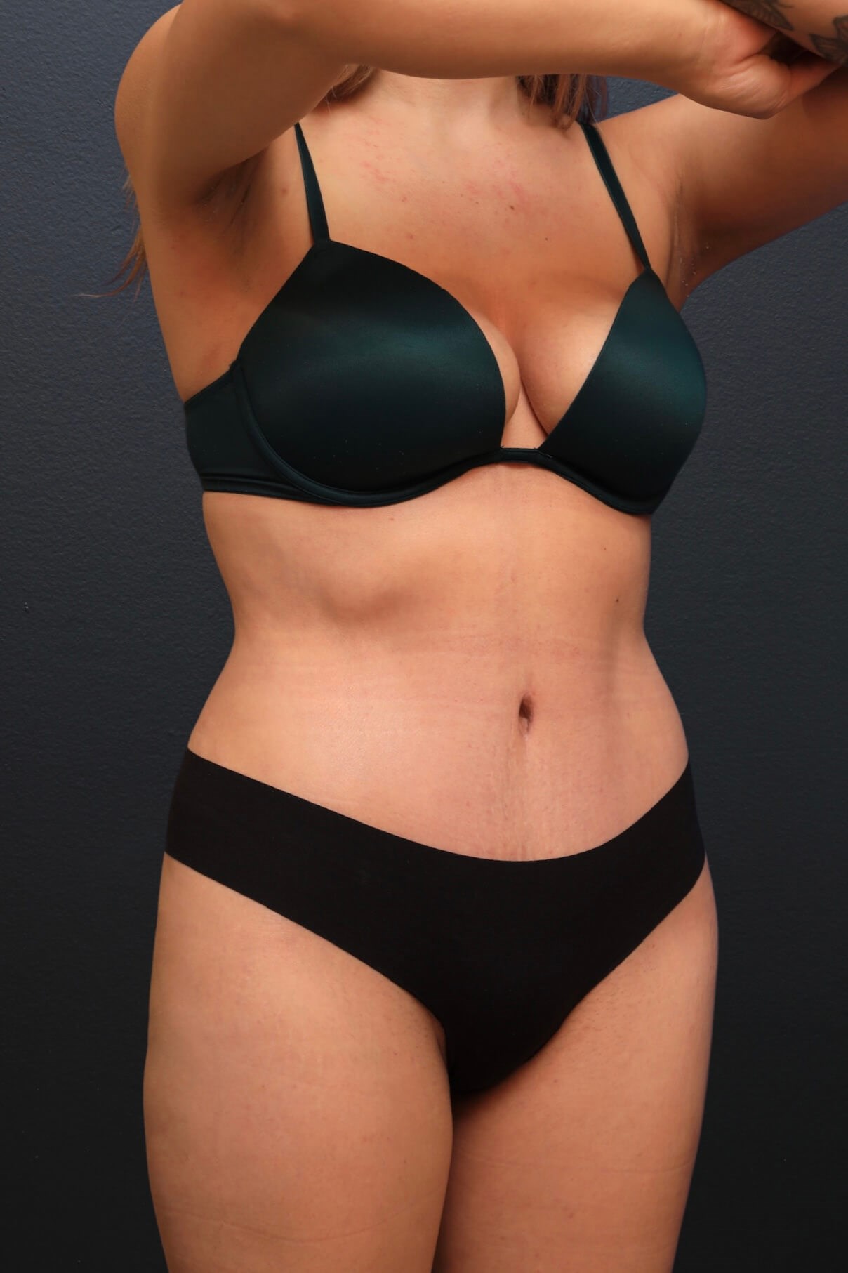Right Oblique After