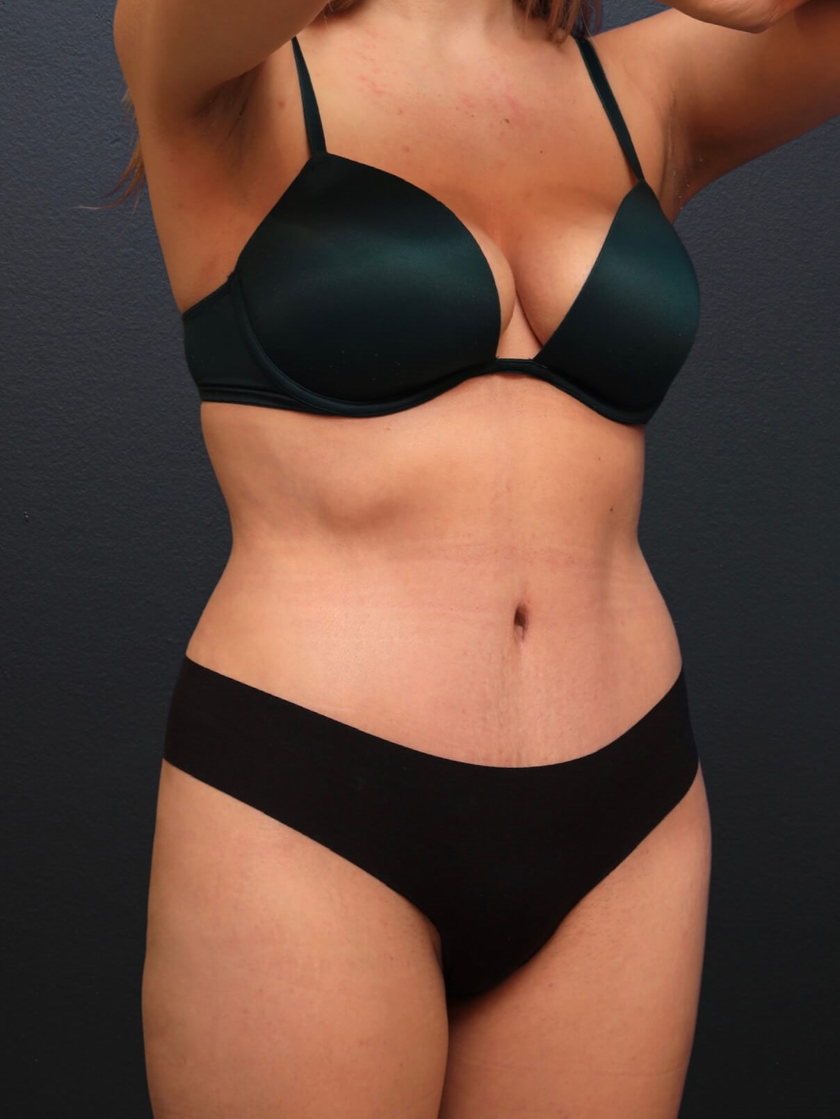 Right Oblique After