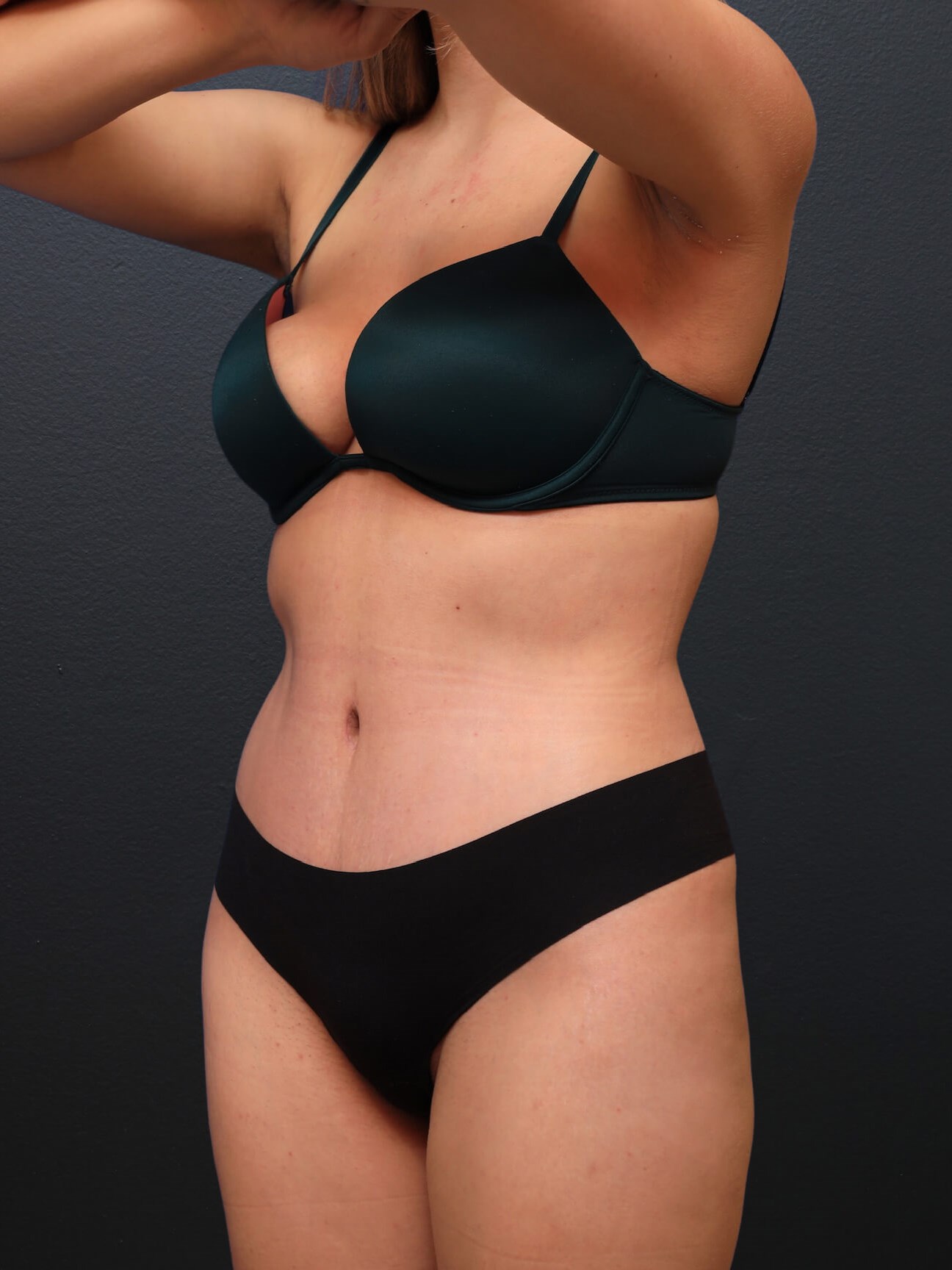 Left Oblique After