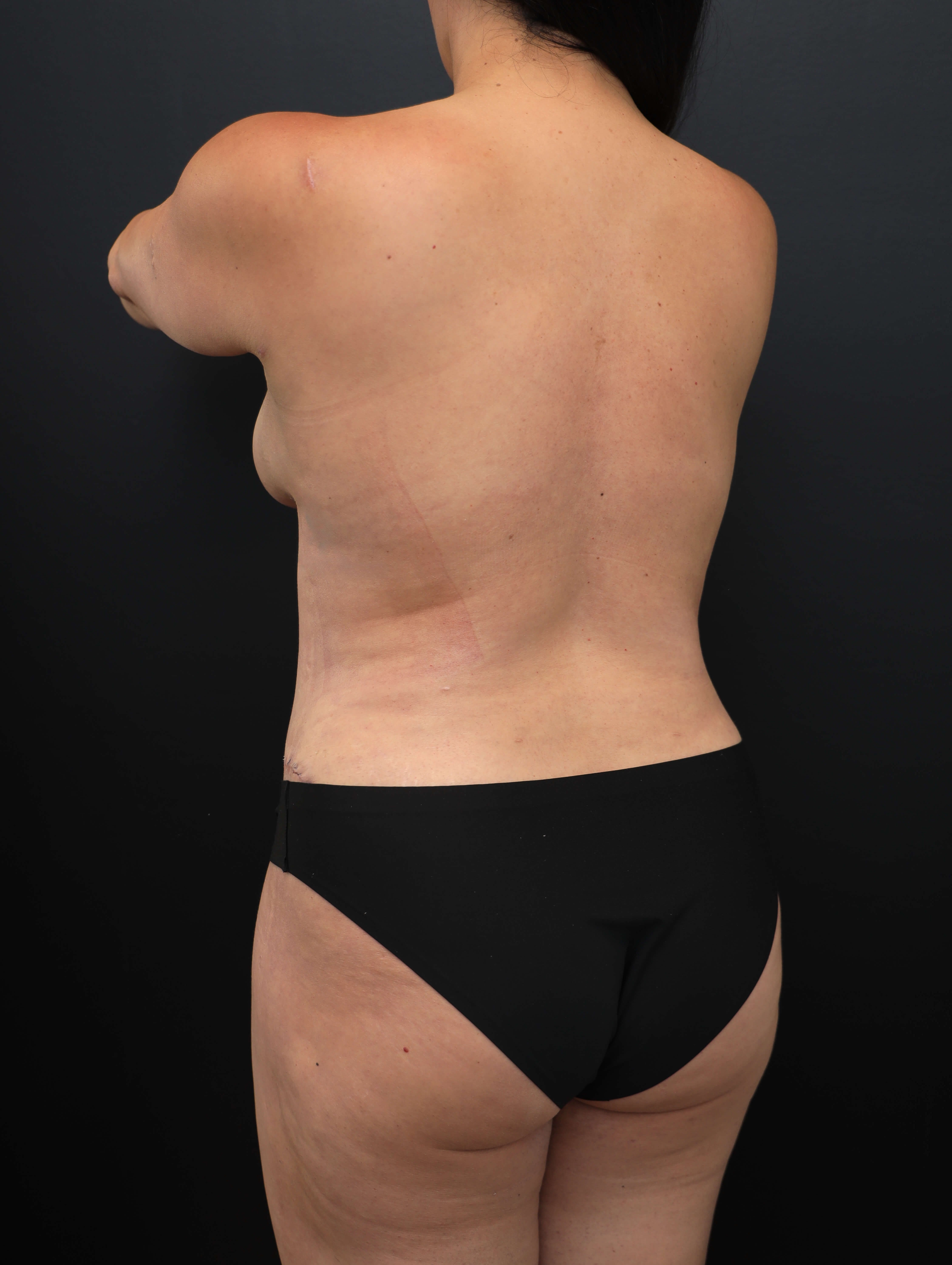 Left Posterior Oblique After