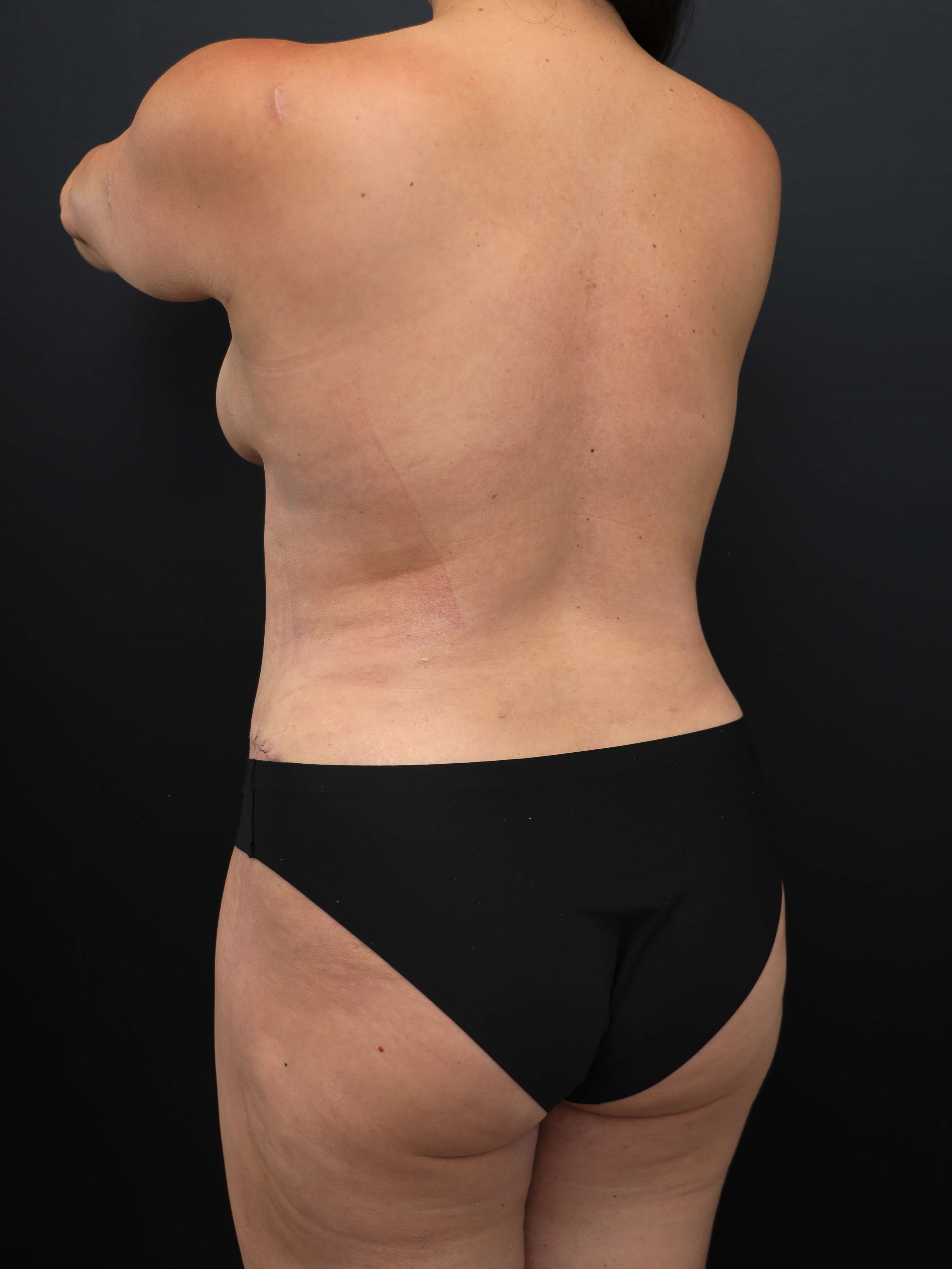 Left Posterior Oblique After