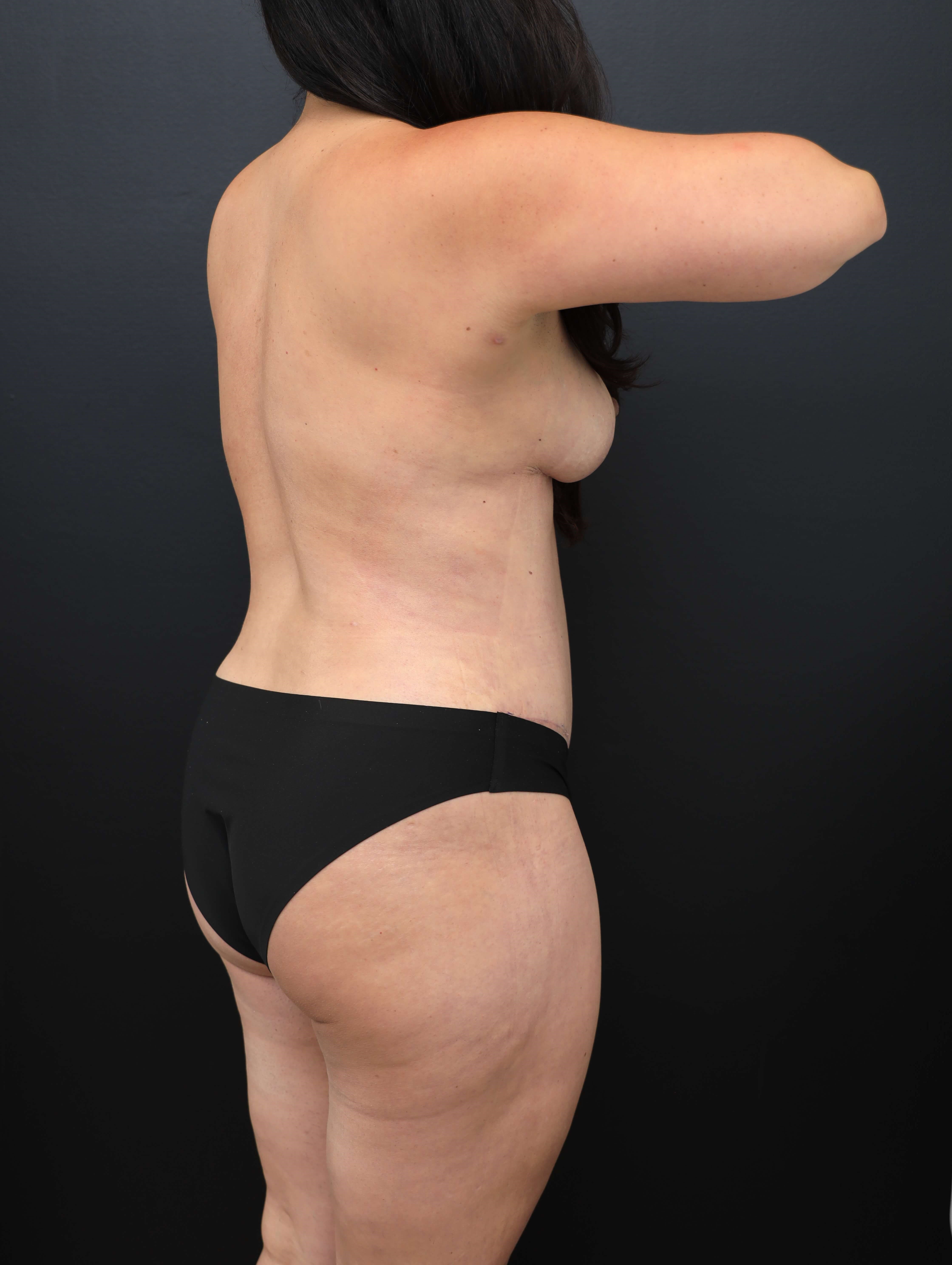 Right Posterior Oblique After