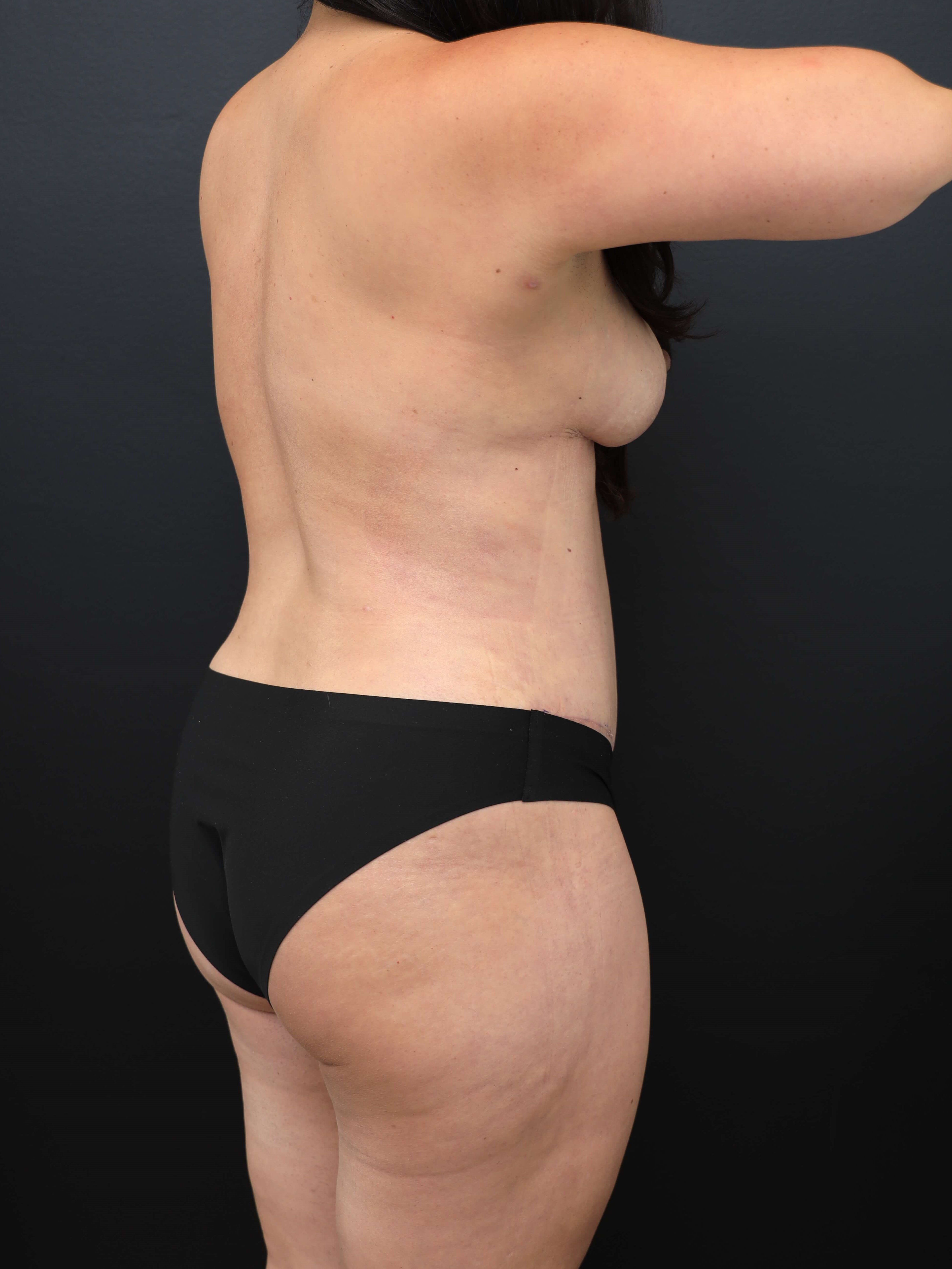 Right Posterior Oblique After