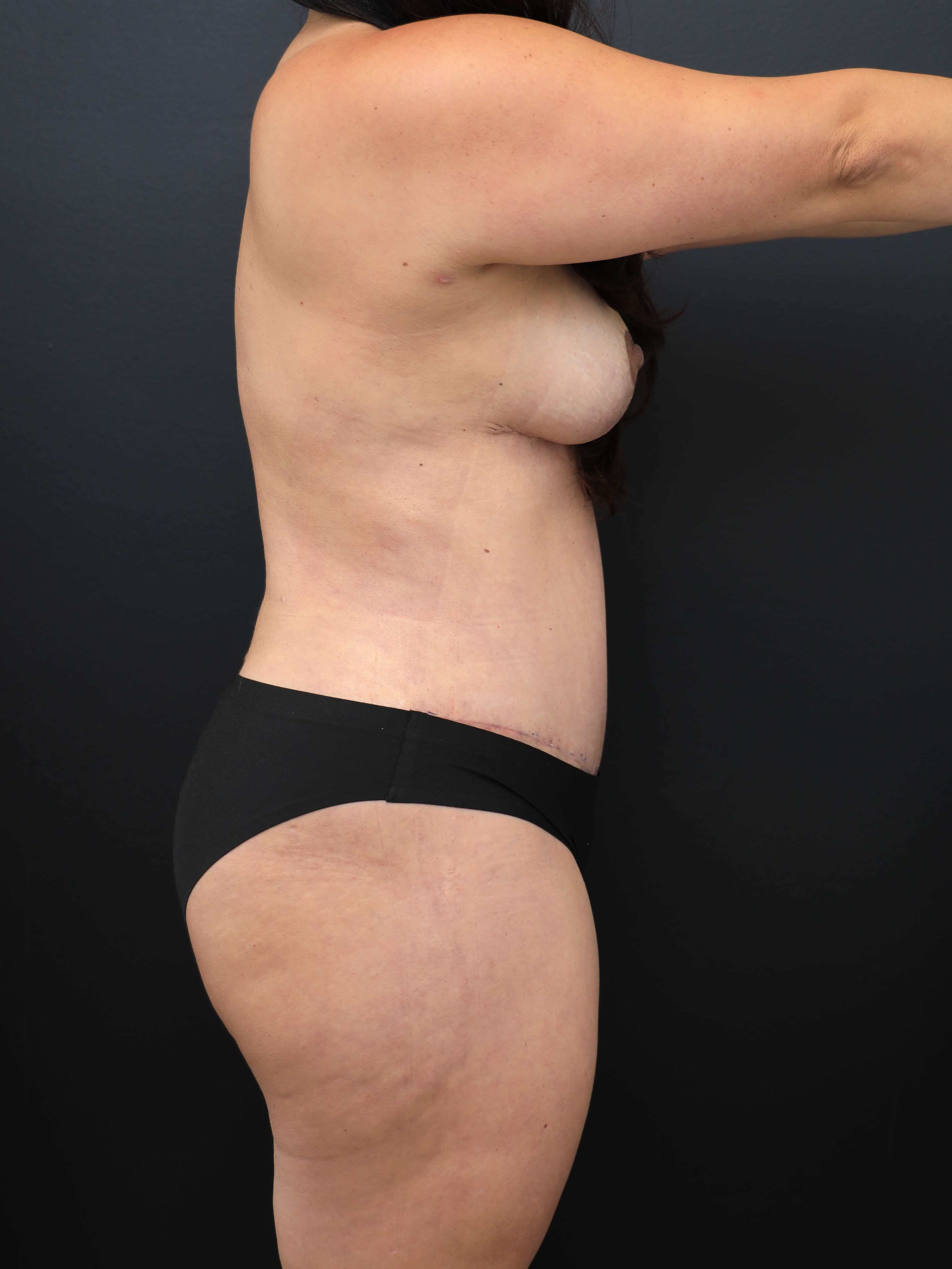 Right Lateral After