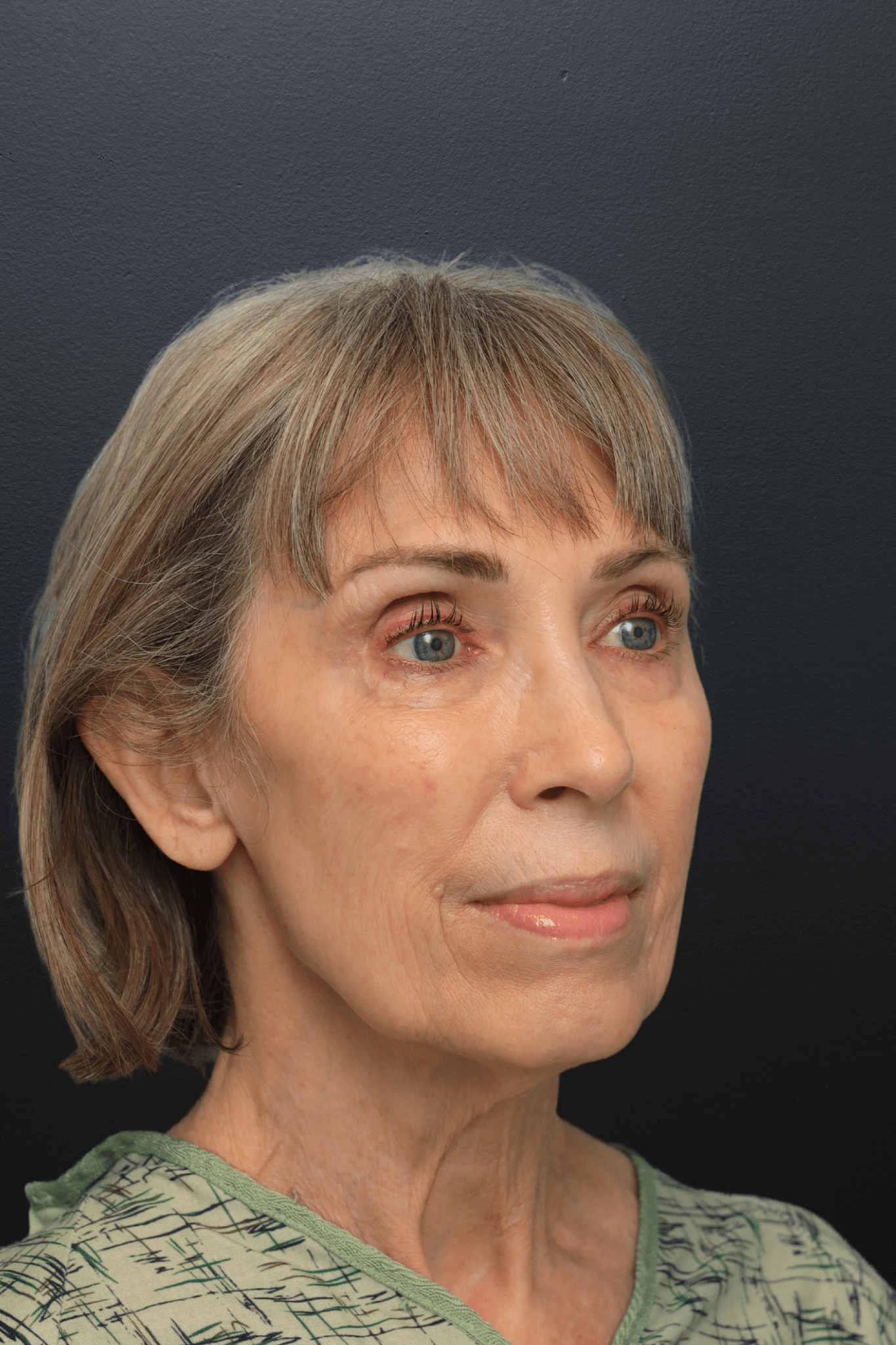 Right Oblique Before