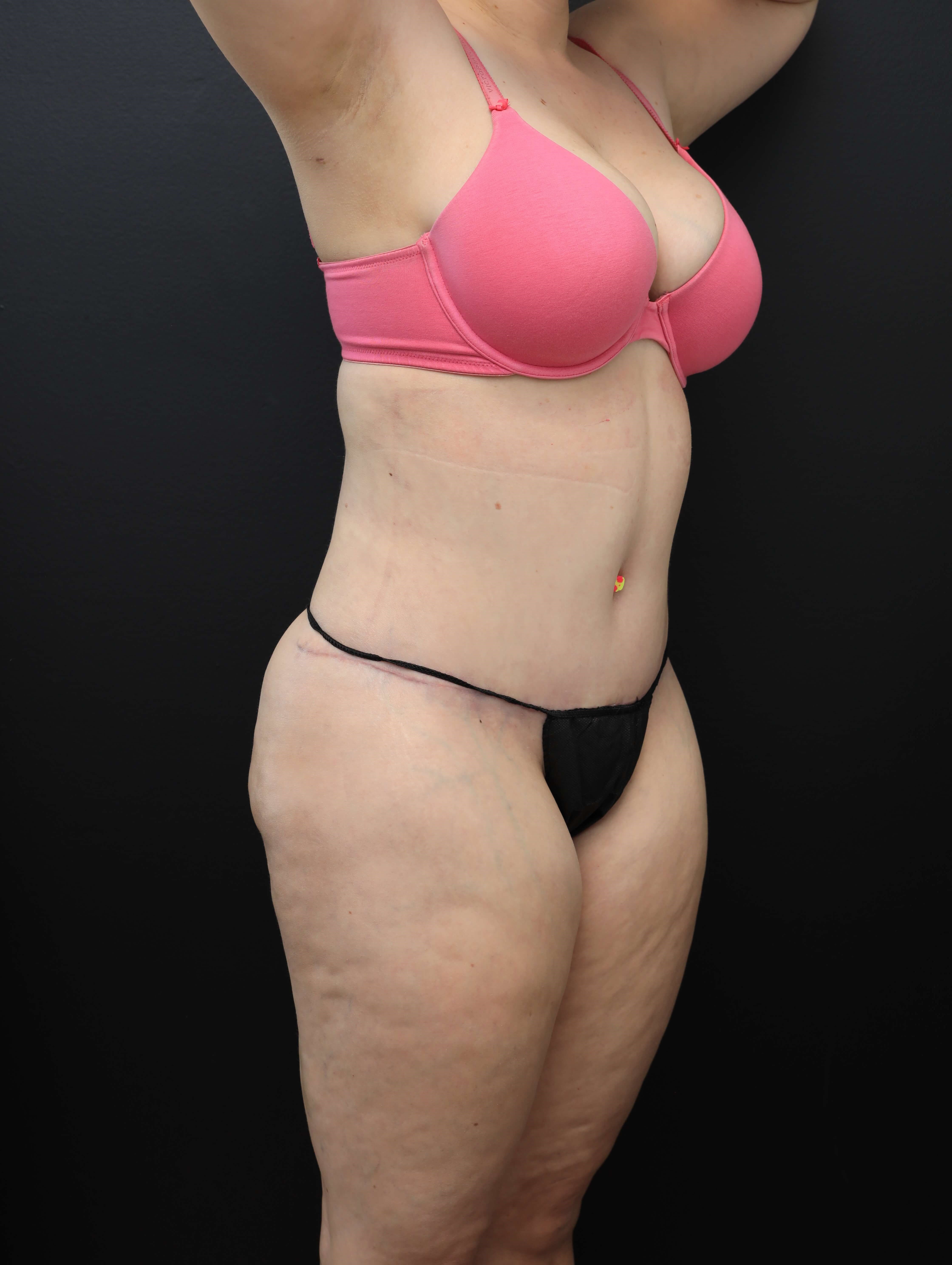 Right Oblique After