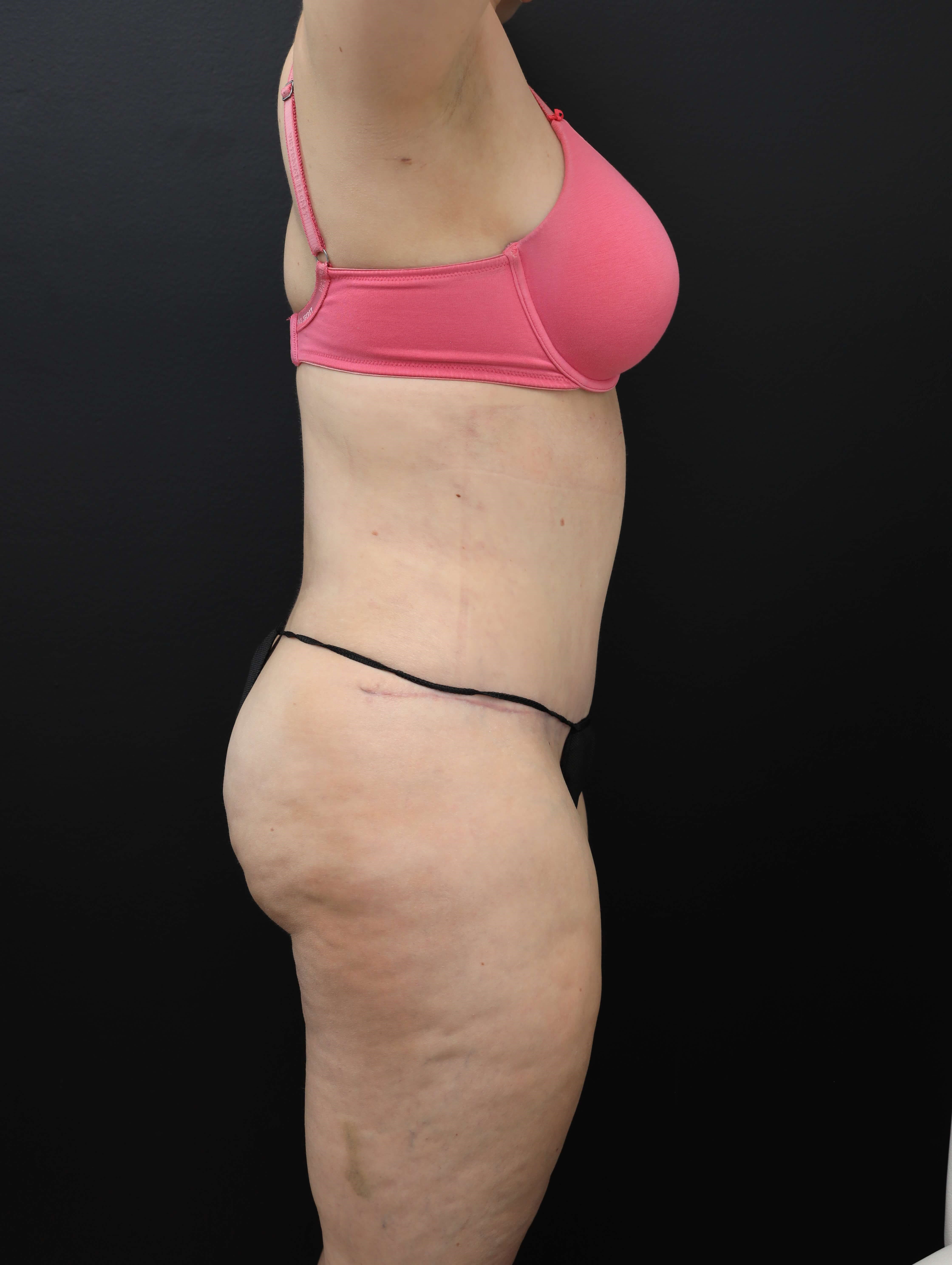 Right Lateral After