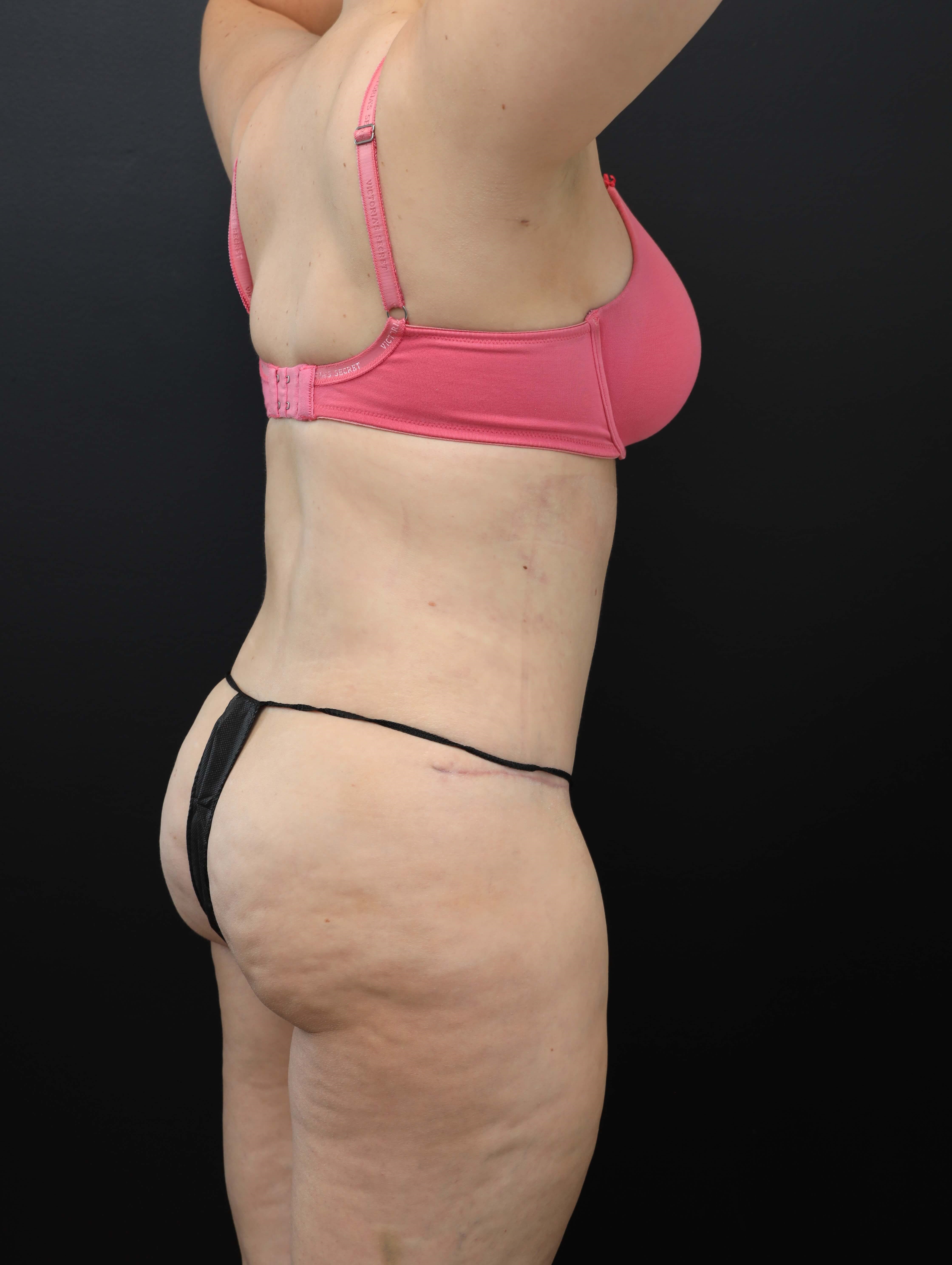 Right Posterior Oblique After