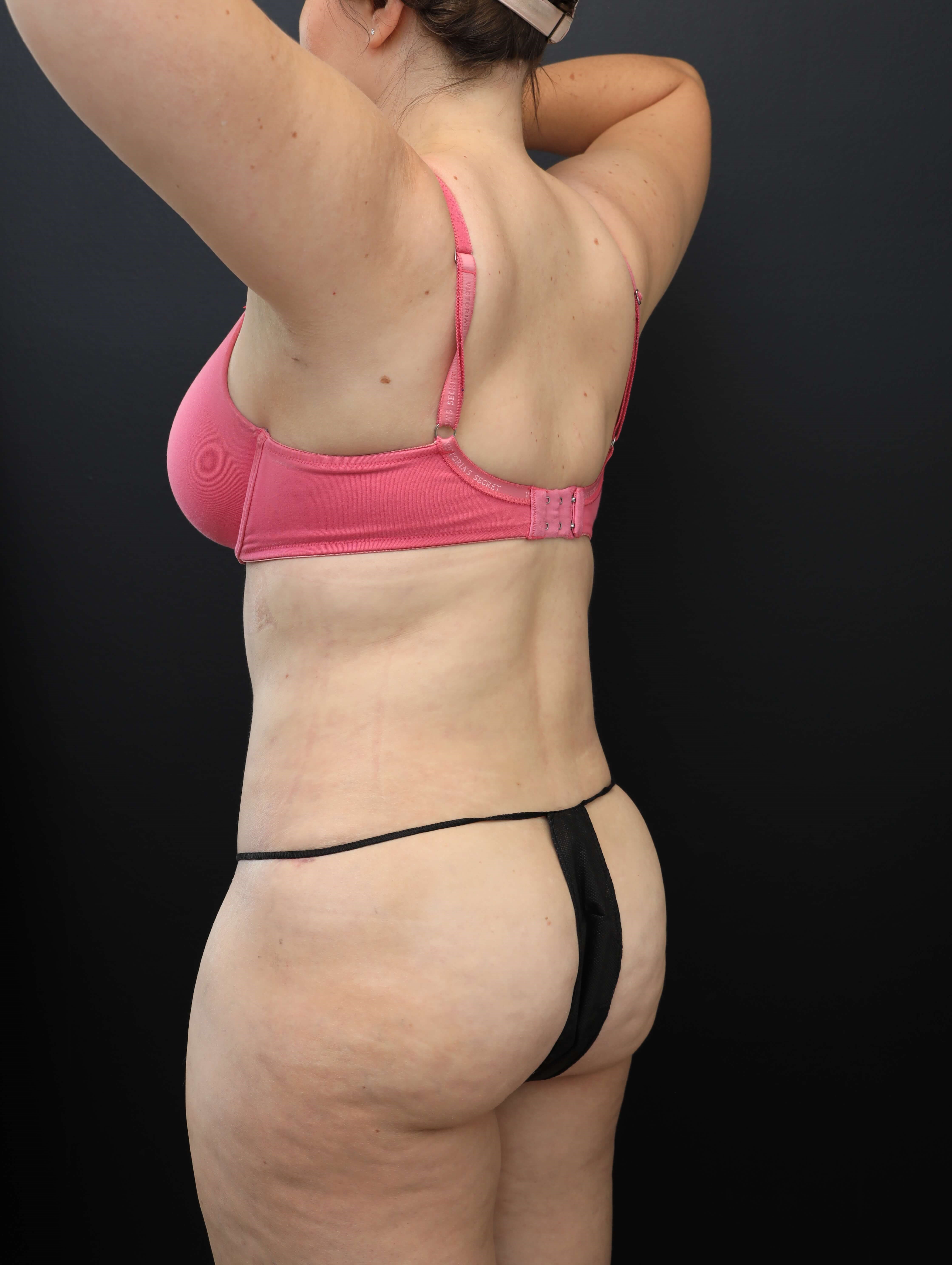 Left Posterior Oblique After
