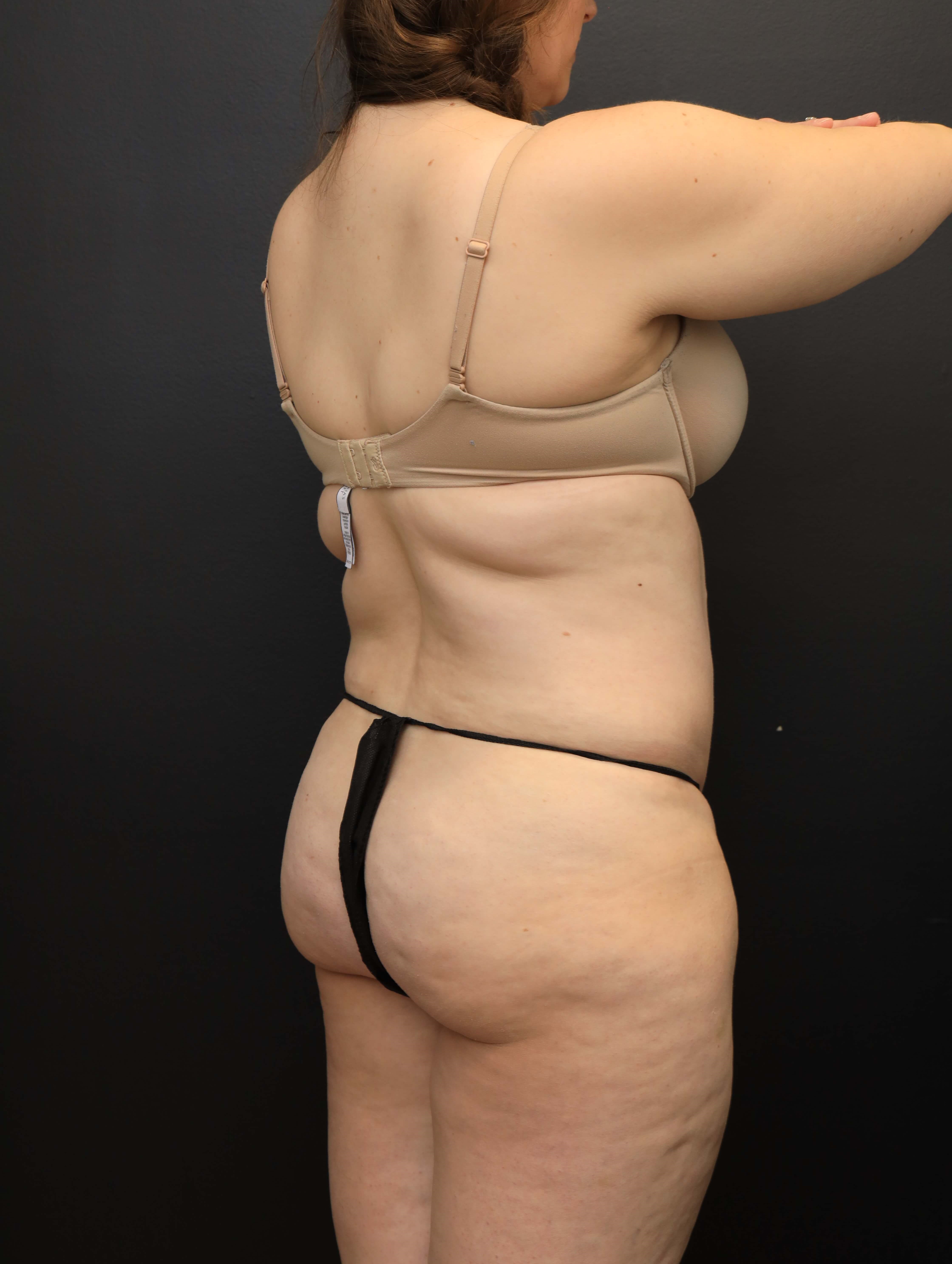 Right Posterior Oblique Before