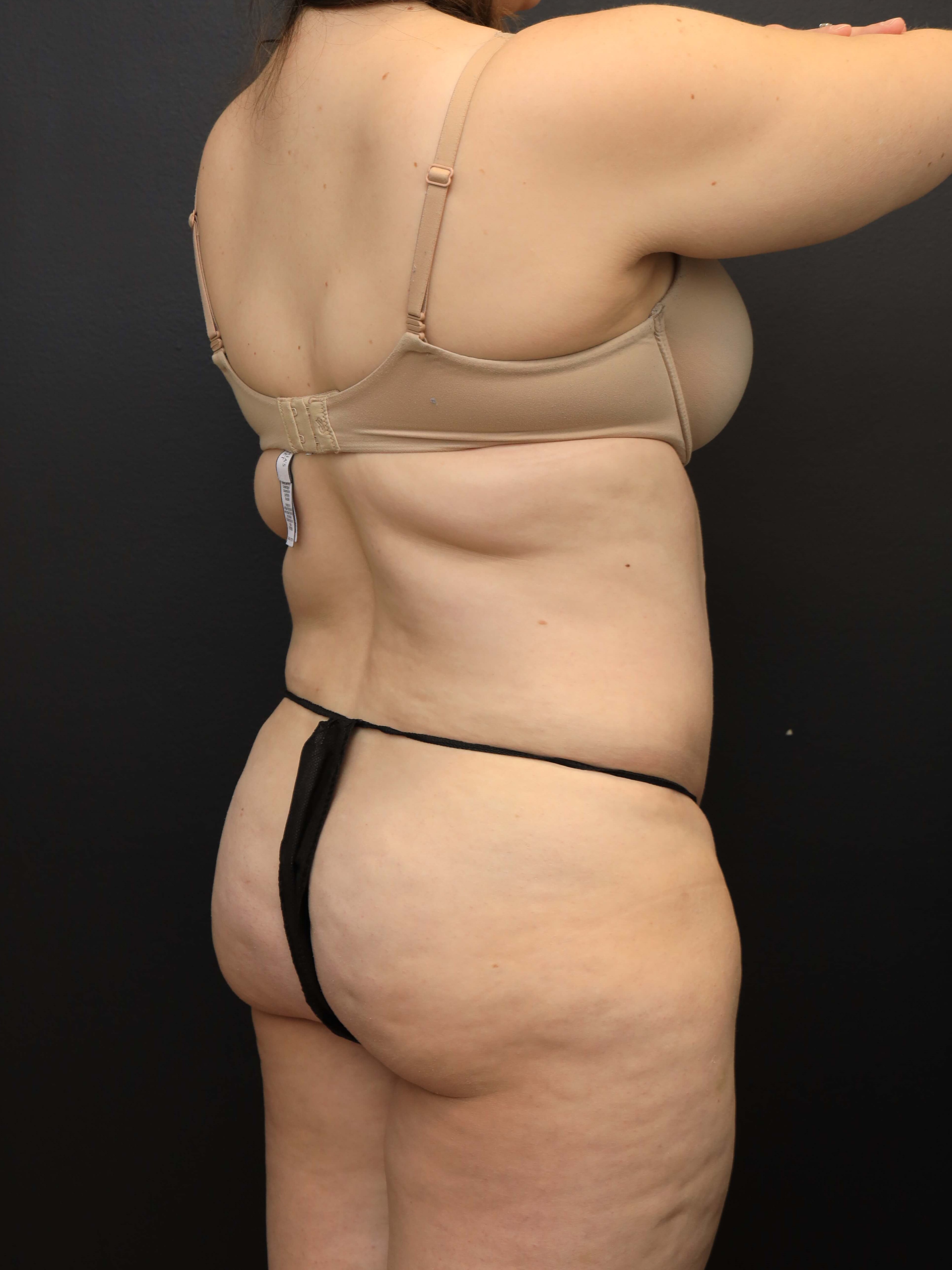 Right Posterior Oblique Before