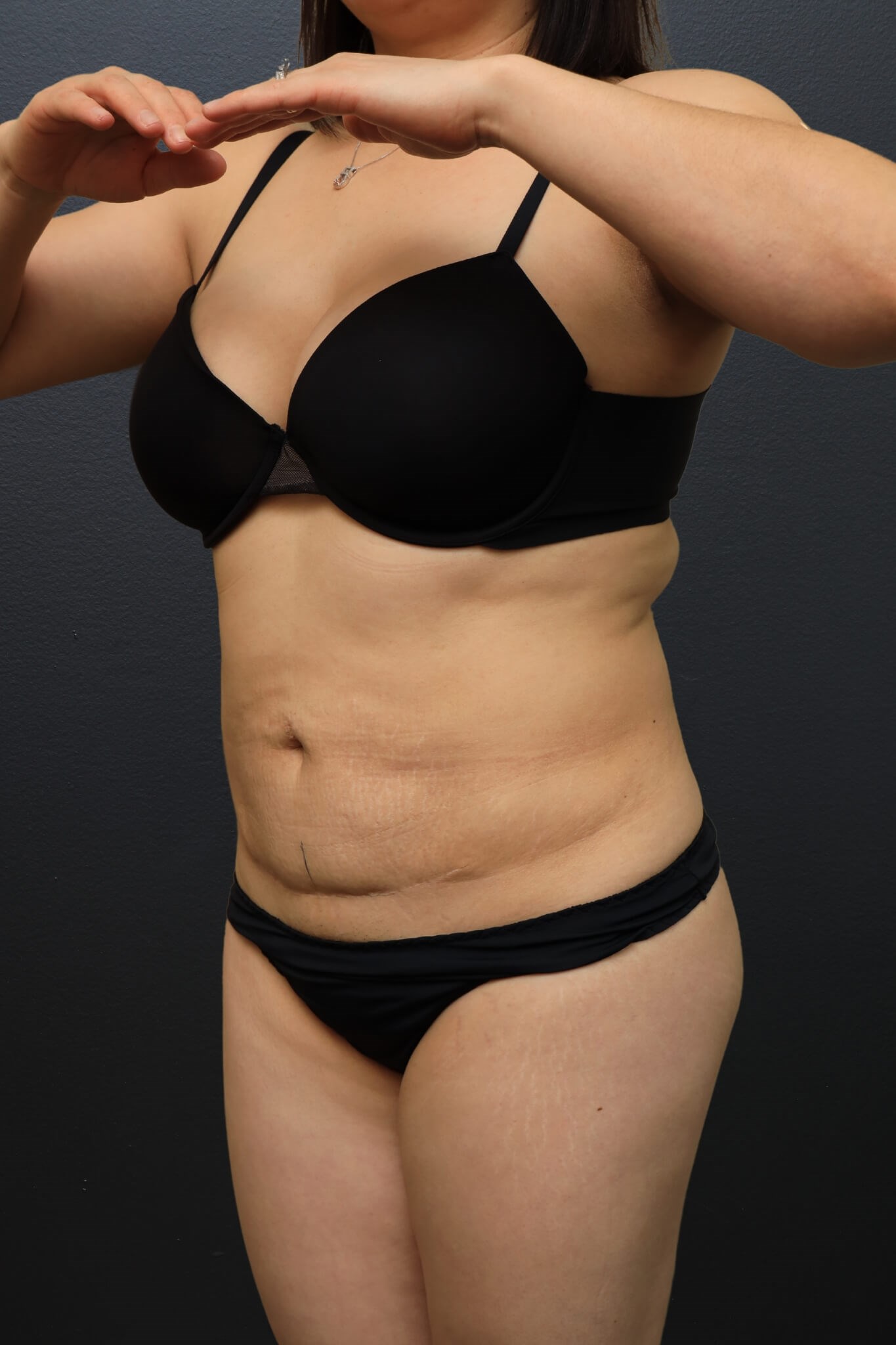 Left Oblique Before