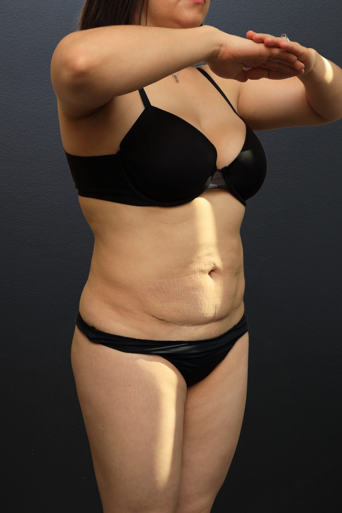Right Oblique Before