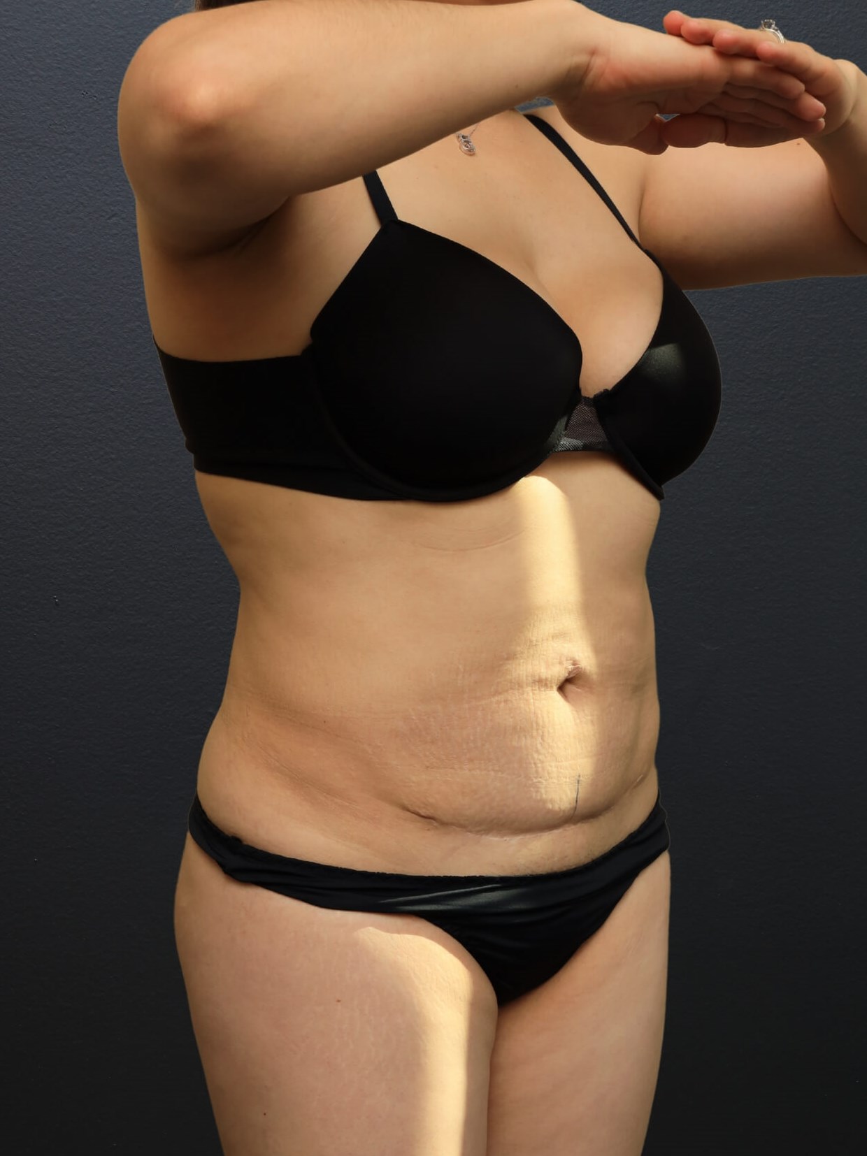 Right Oblique Before