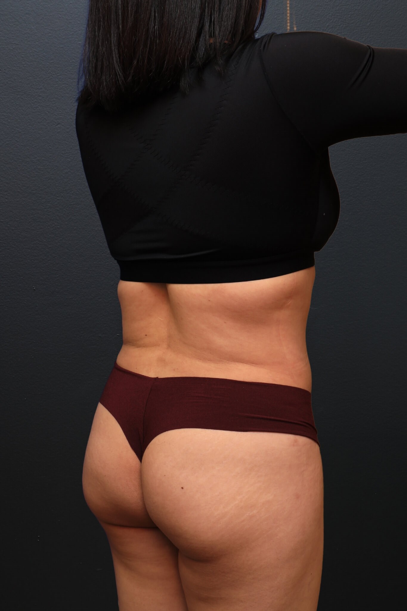 Right Posterior Oblique After