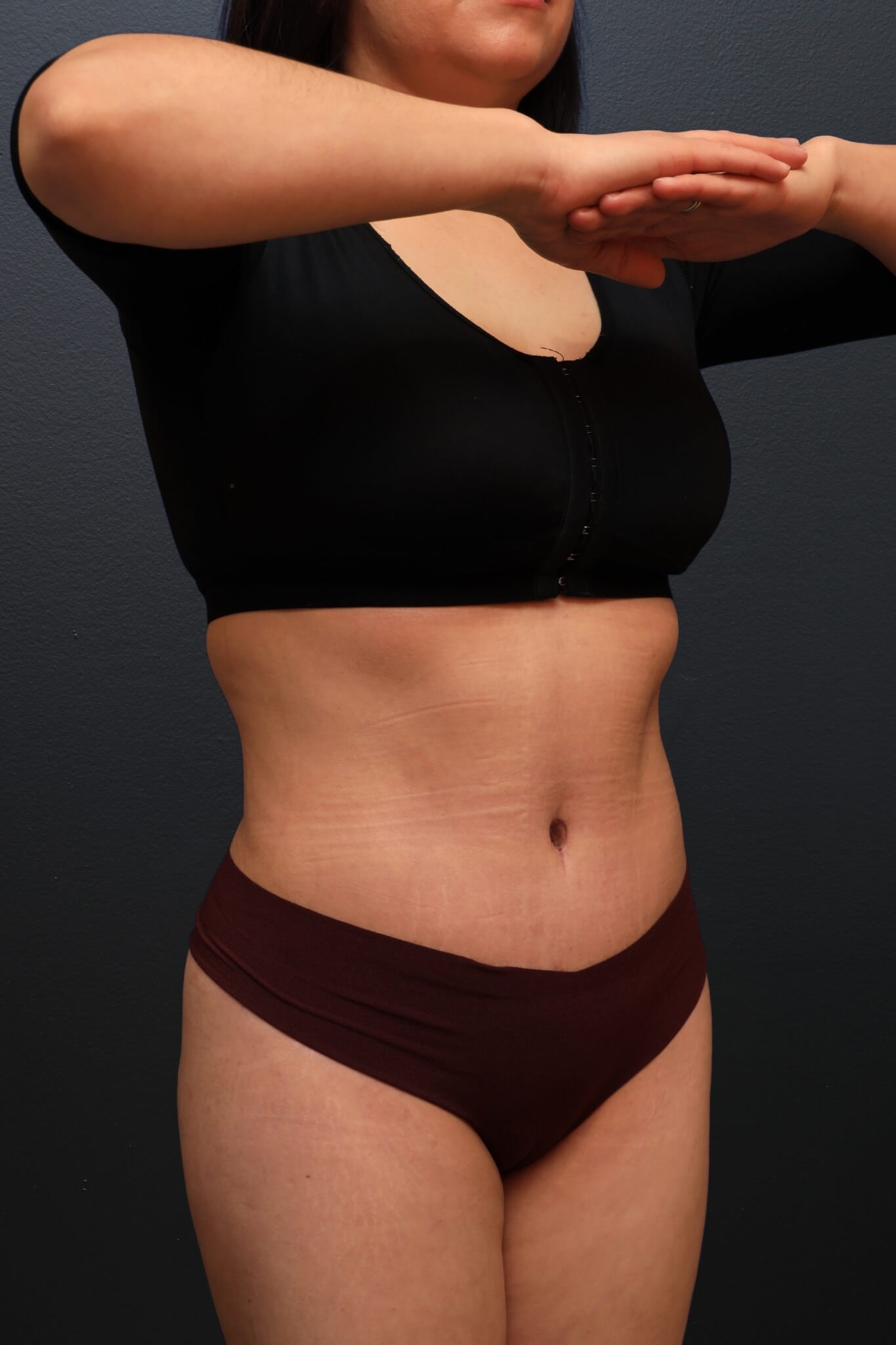 Right Oblique After