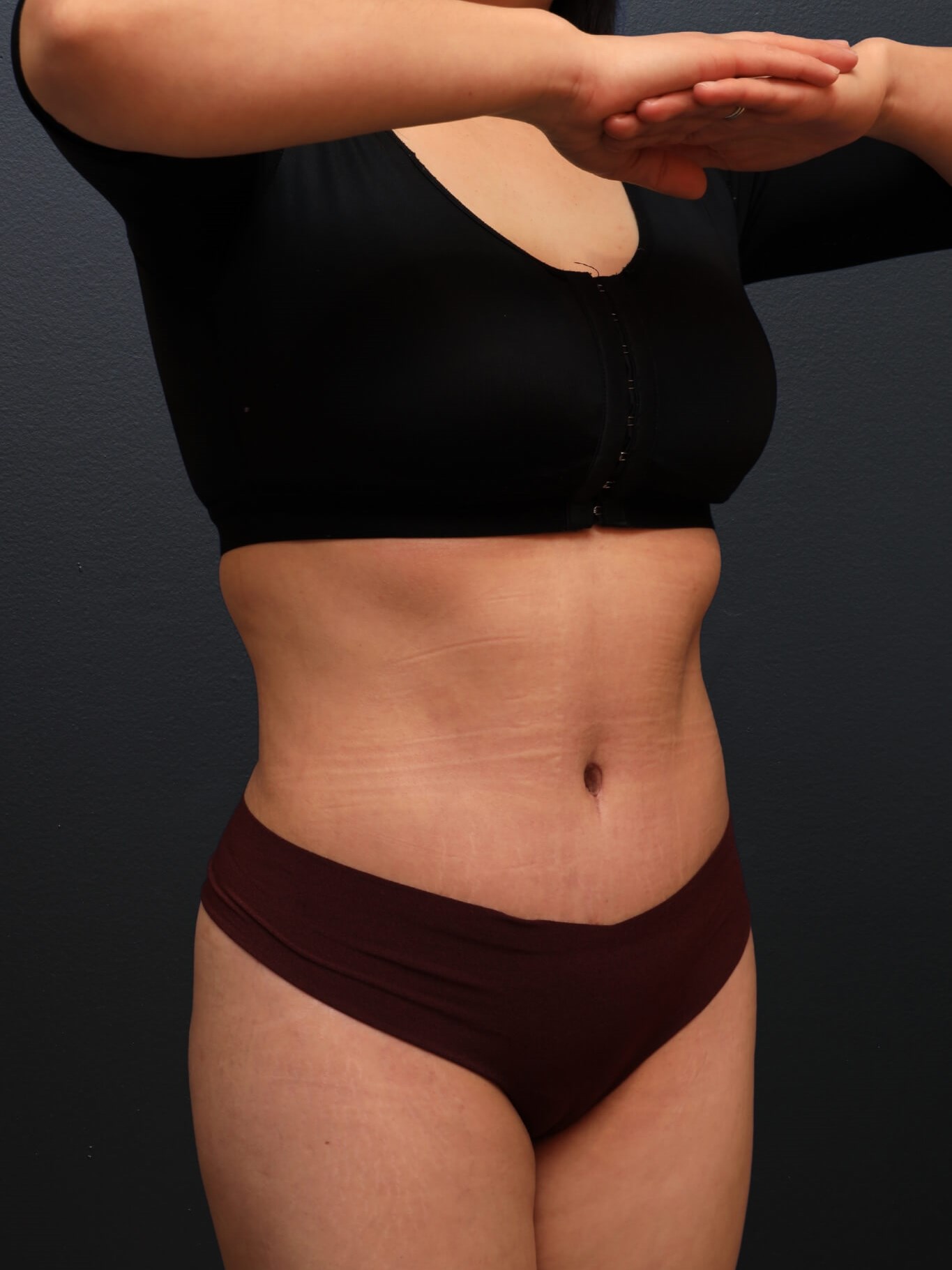 Right Oblique After