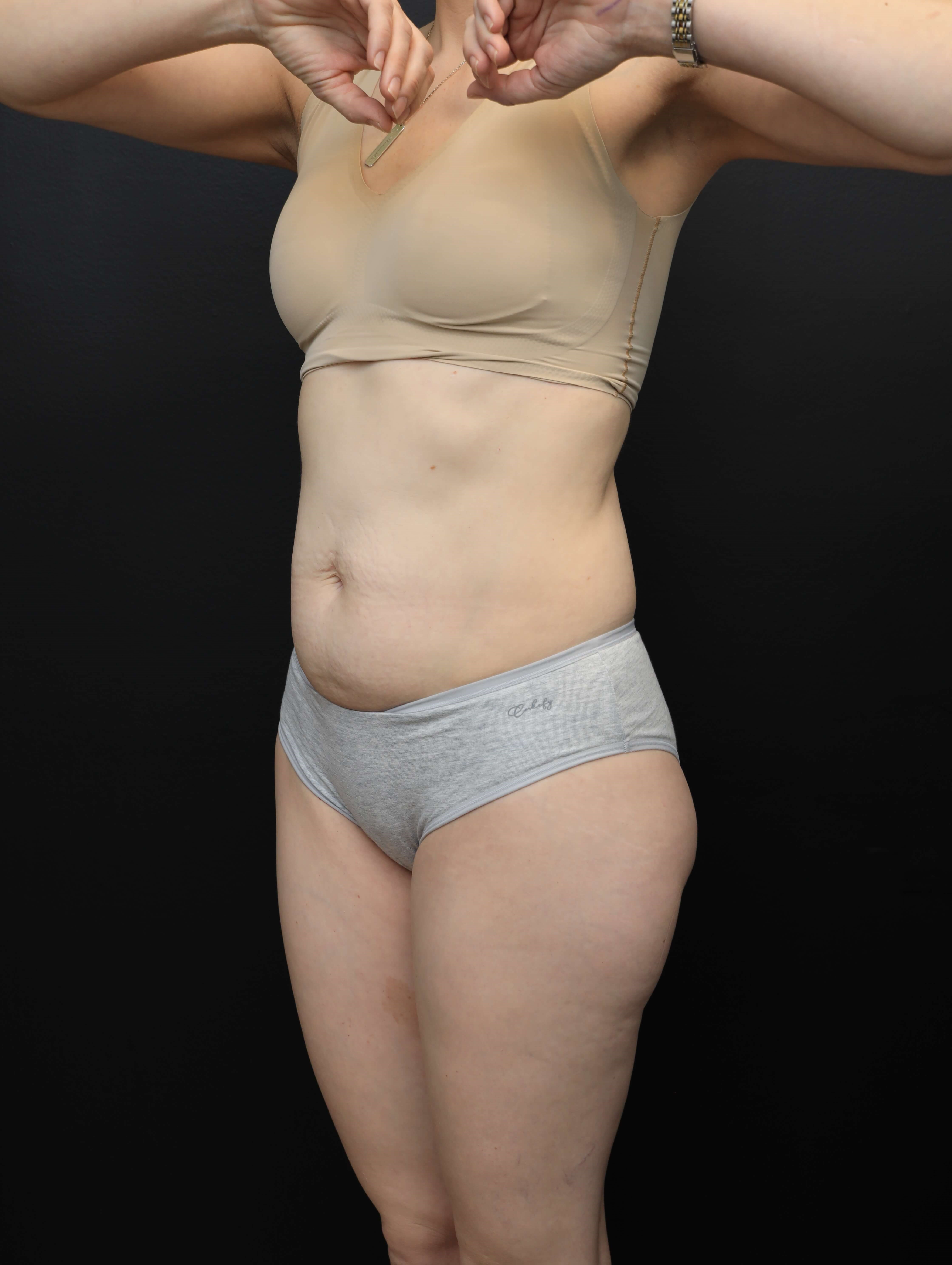 Left Oblique Before