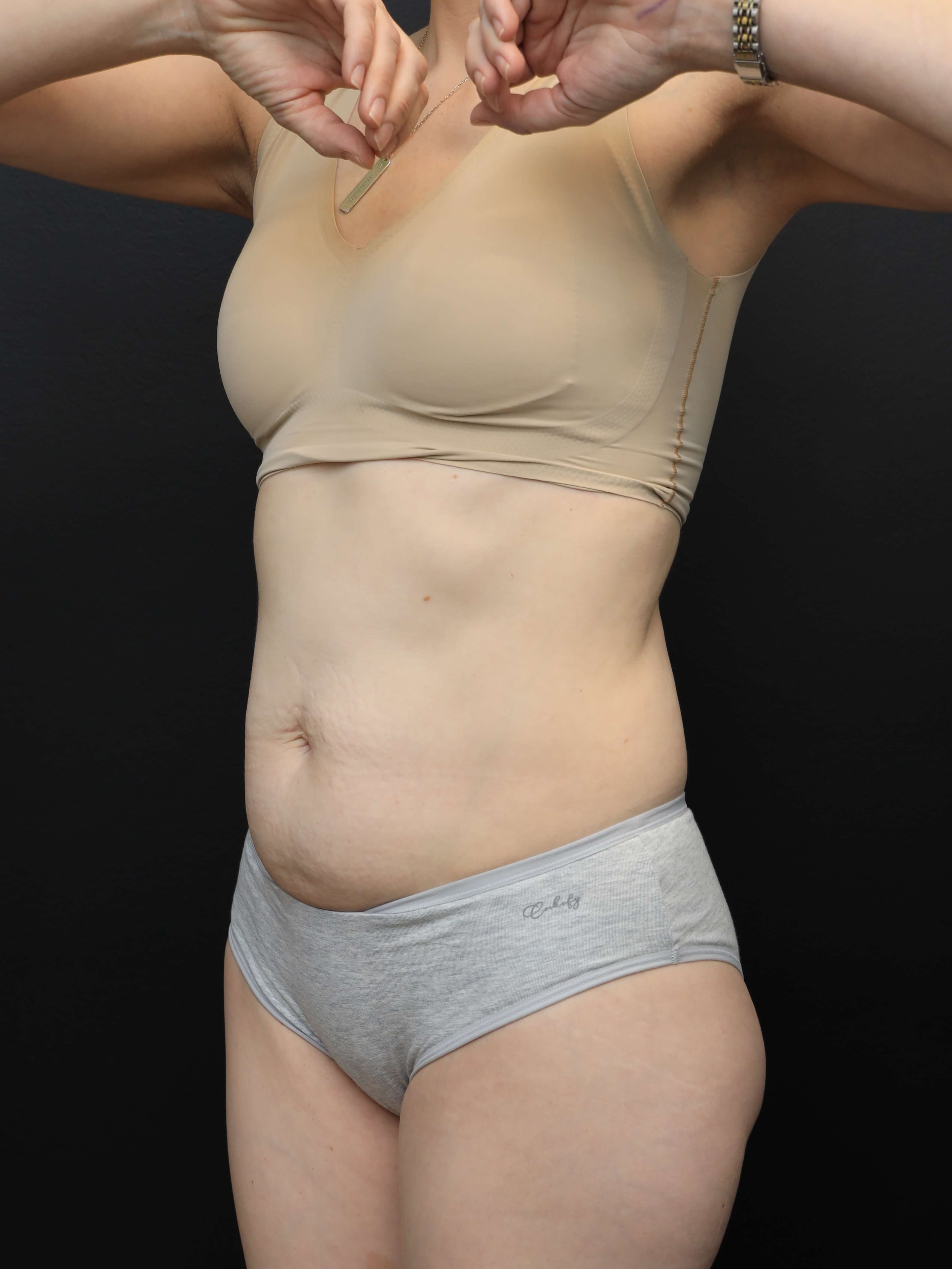 Left Oblique Before
