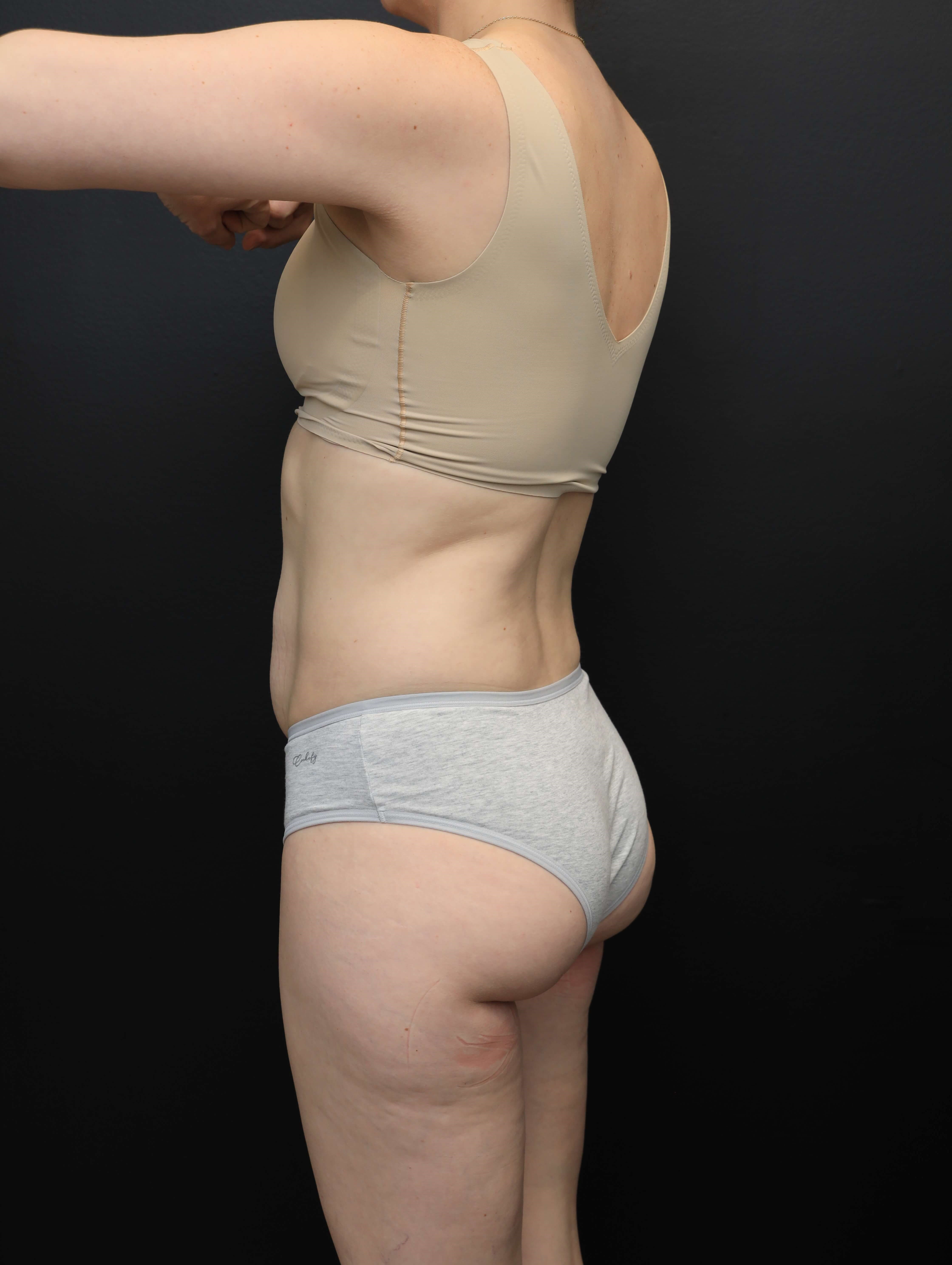 Left Posterior Oblique Before