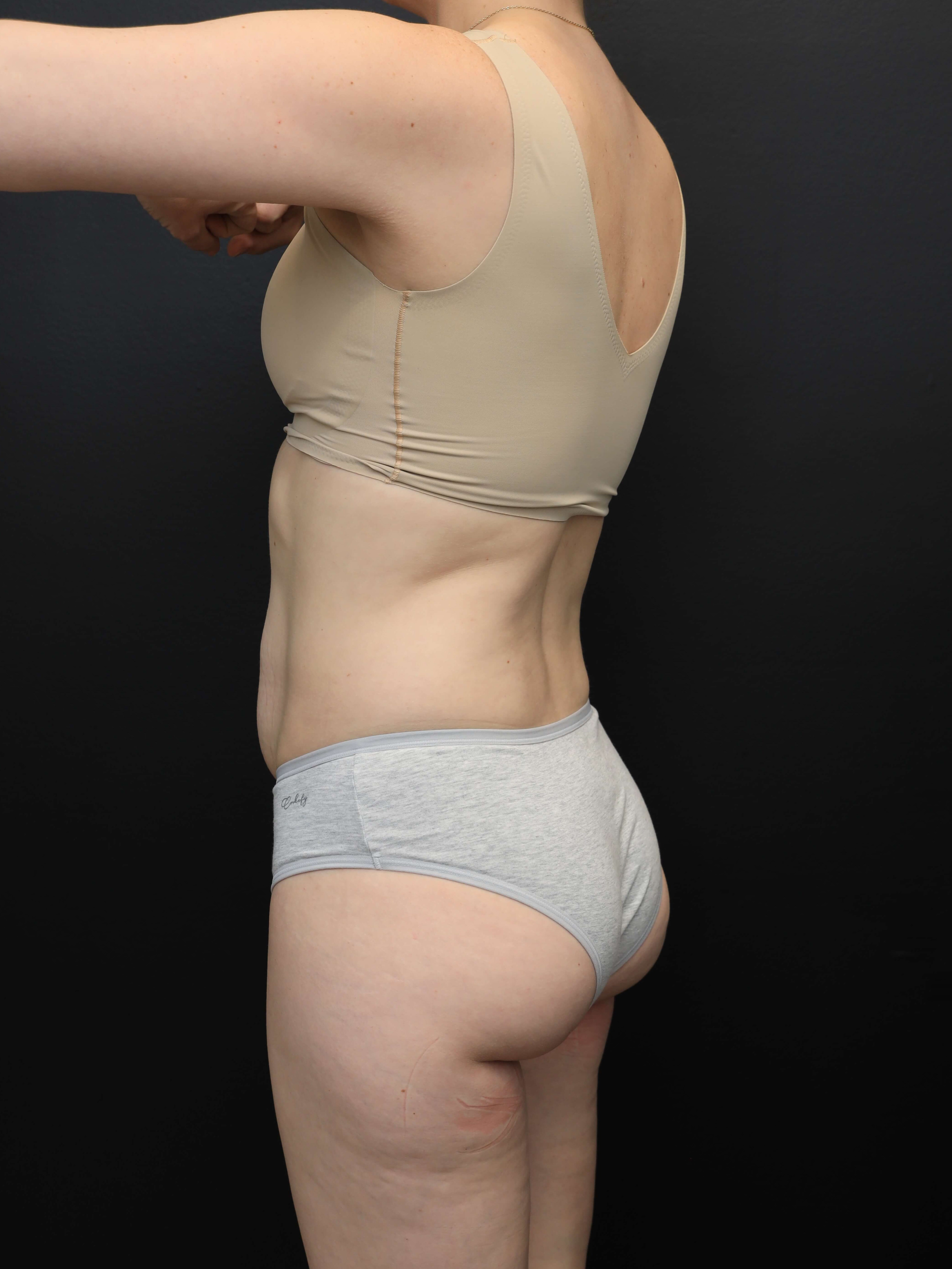 Left Posterior Oblique Before