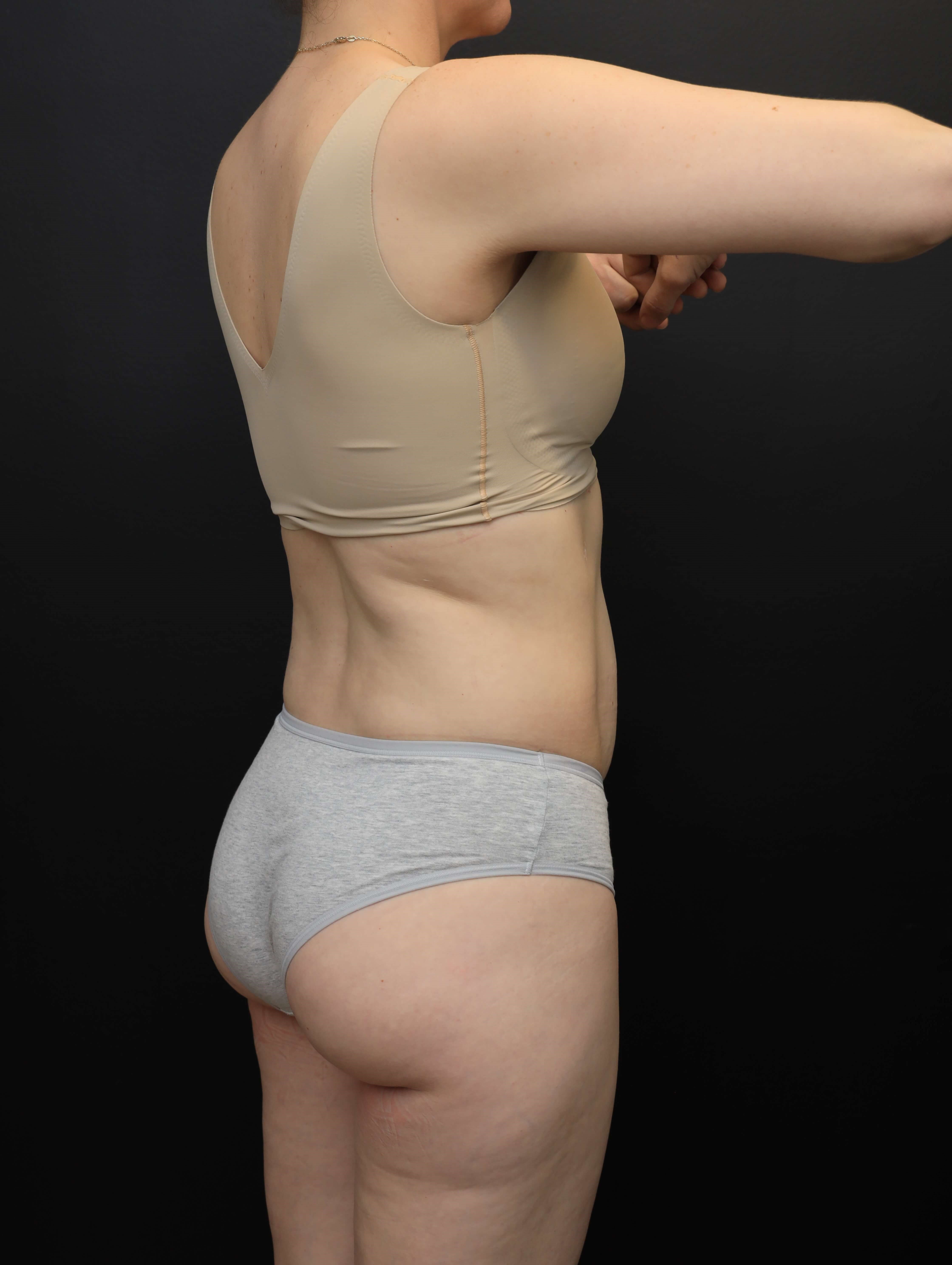 Right Posterior Oblique Before