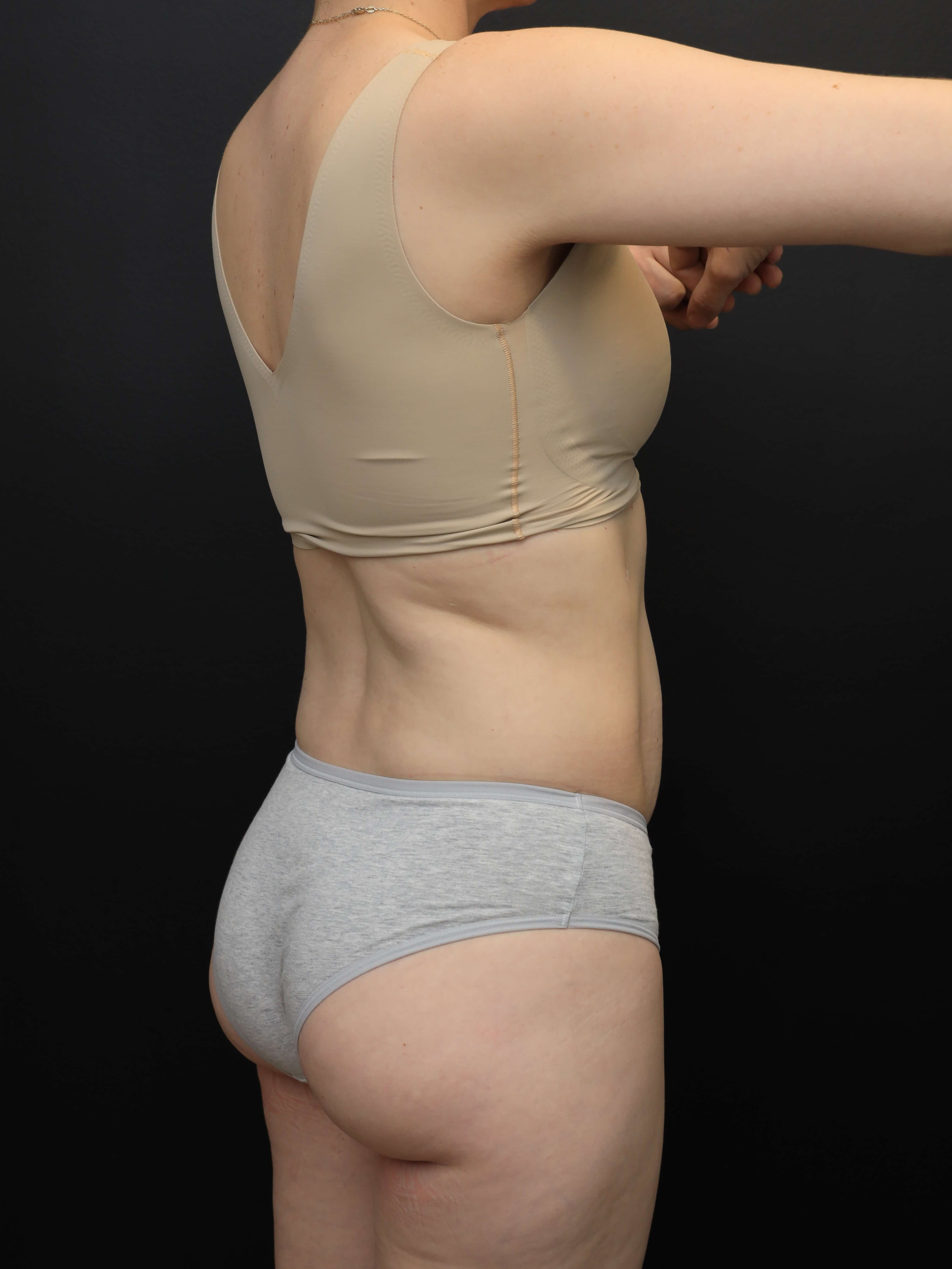 Right Posterior Oblique Before