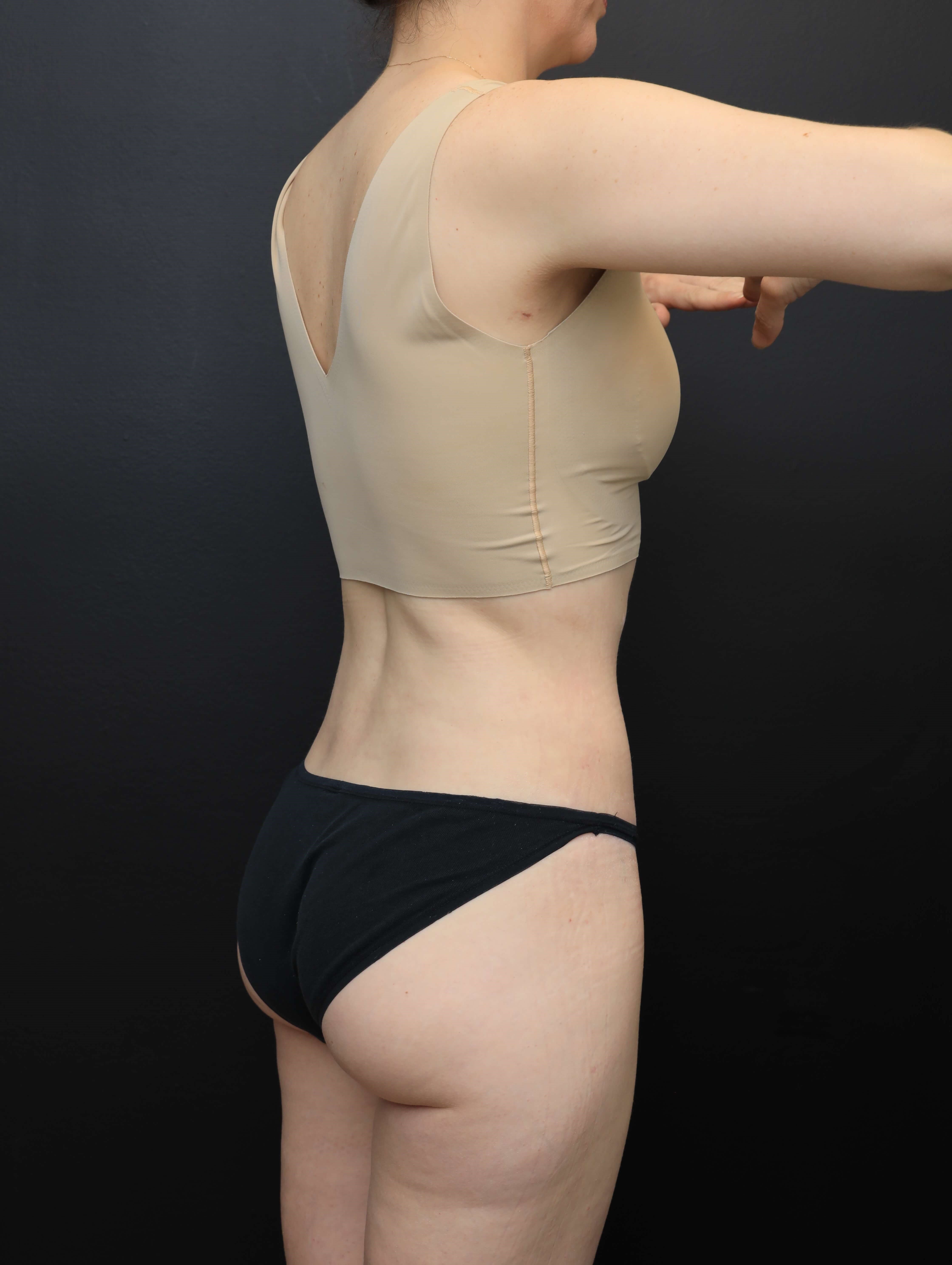 Right Posterior Oblique After