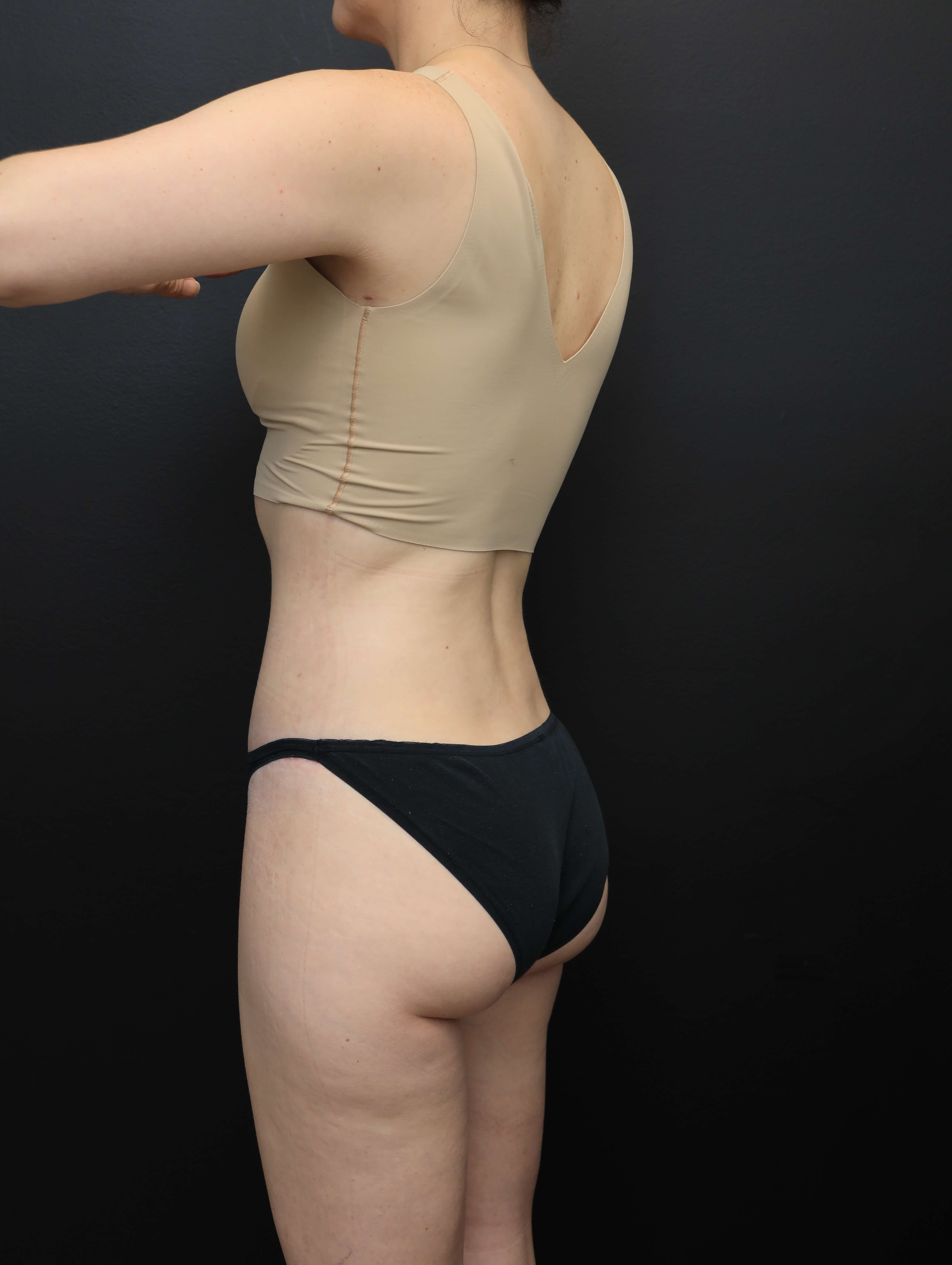 Left Posterior Oblique After