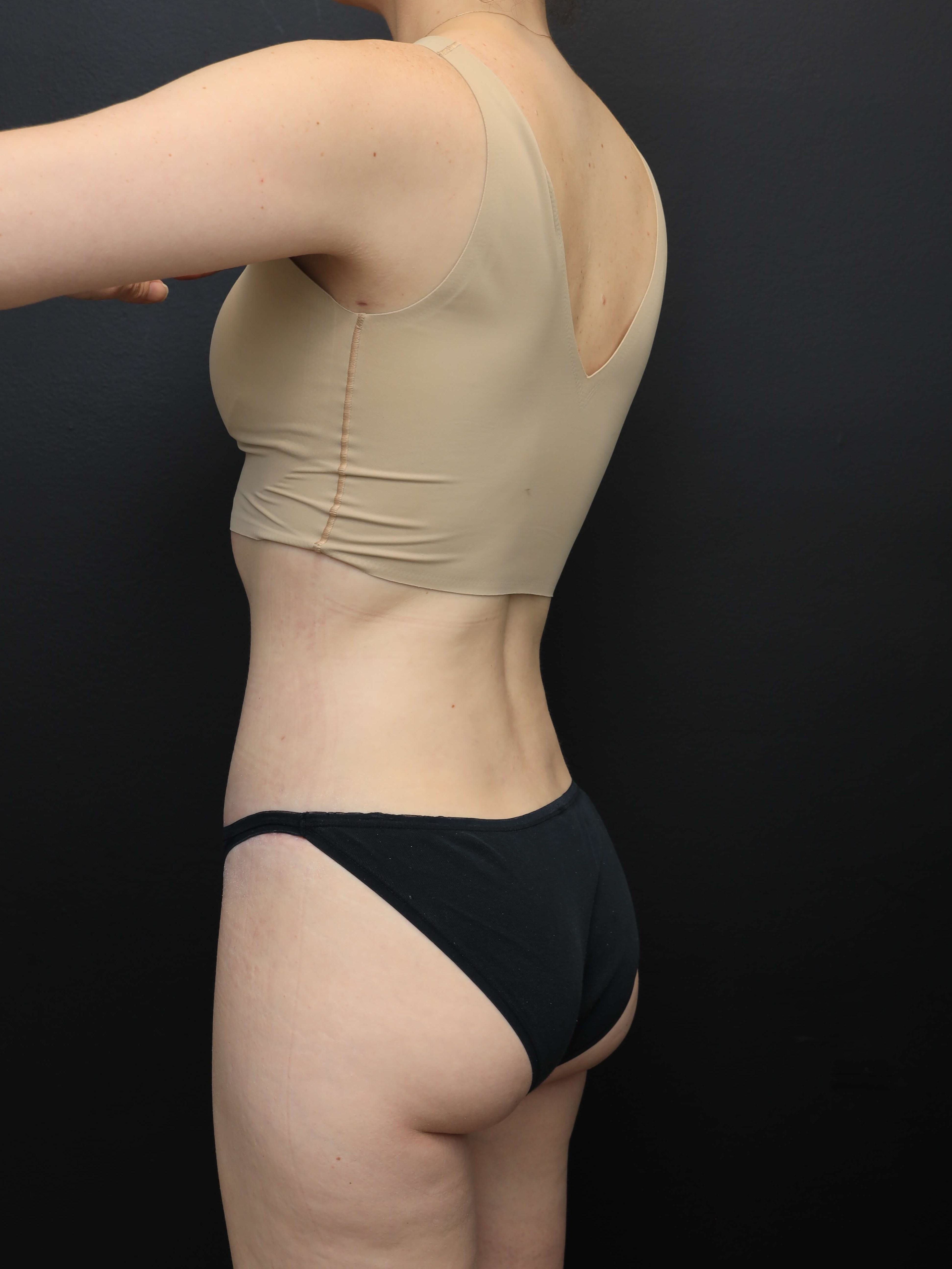 Left Posterior Oblique After
