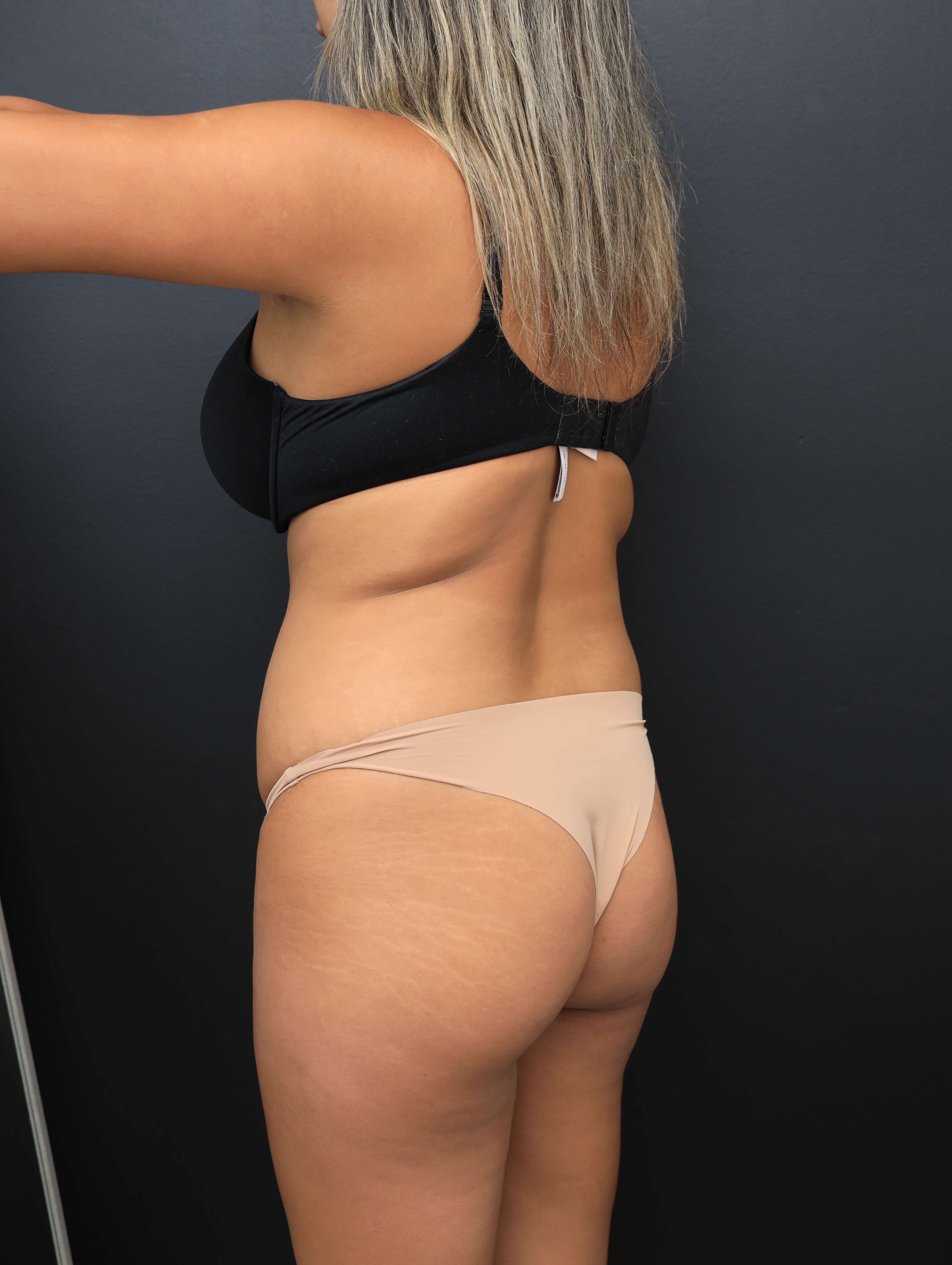 Left Posterior Oblique Before