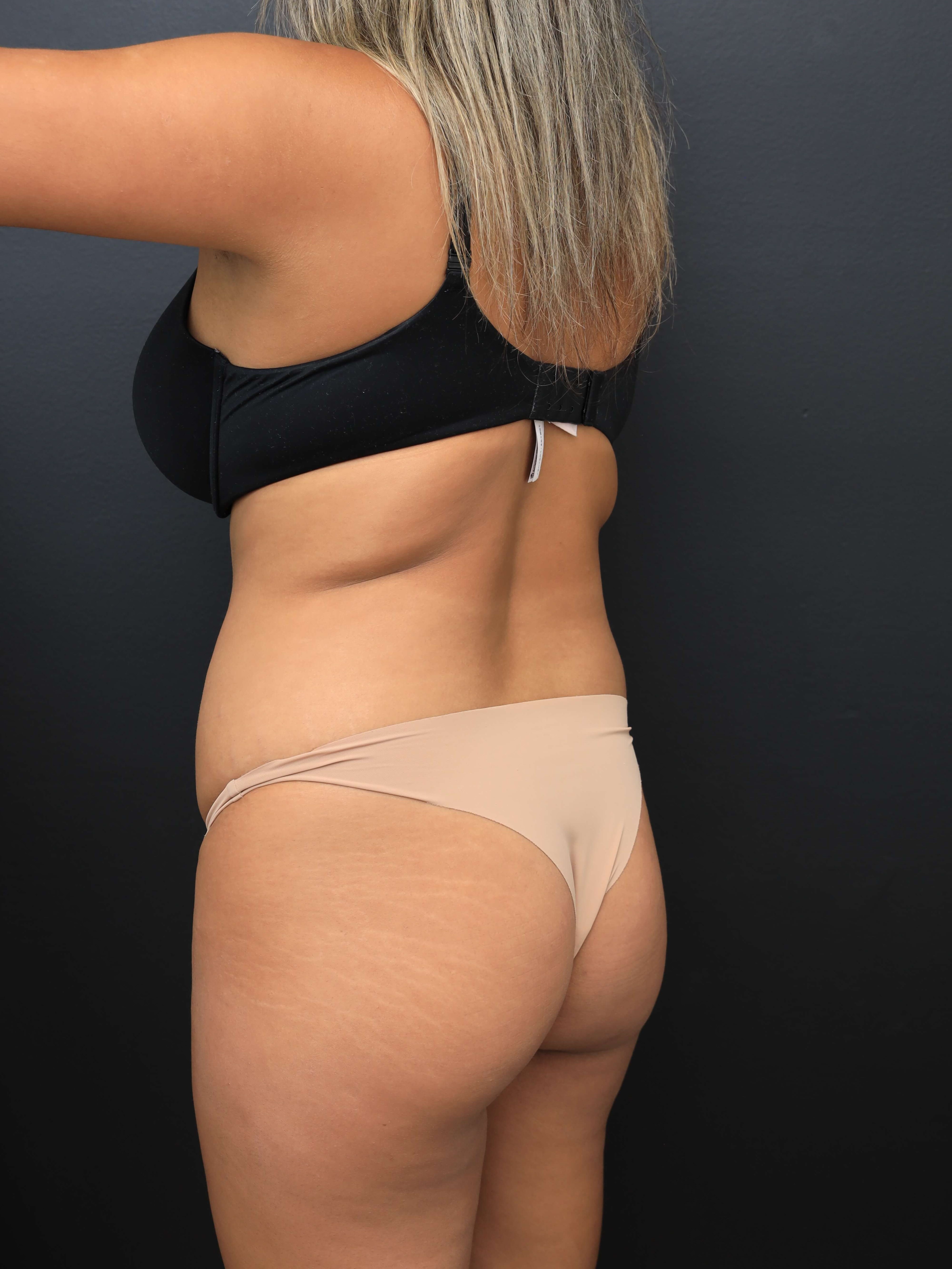 Left Posterior Oblique Before
