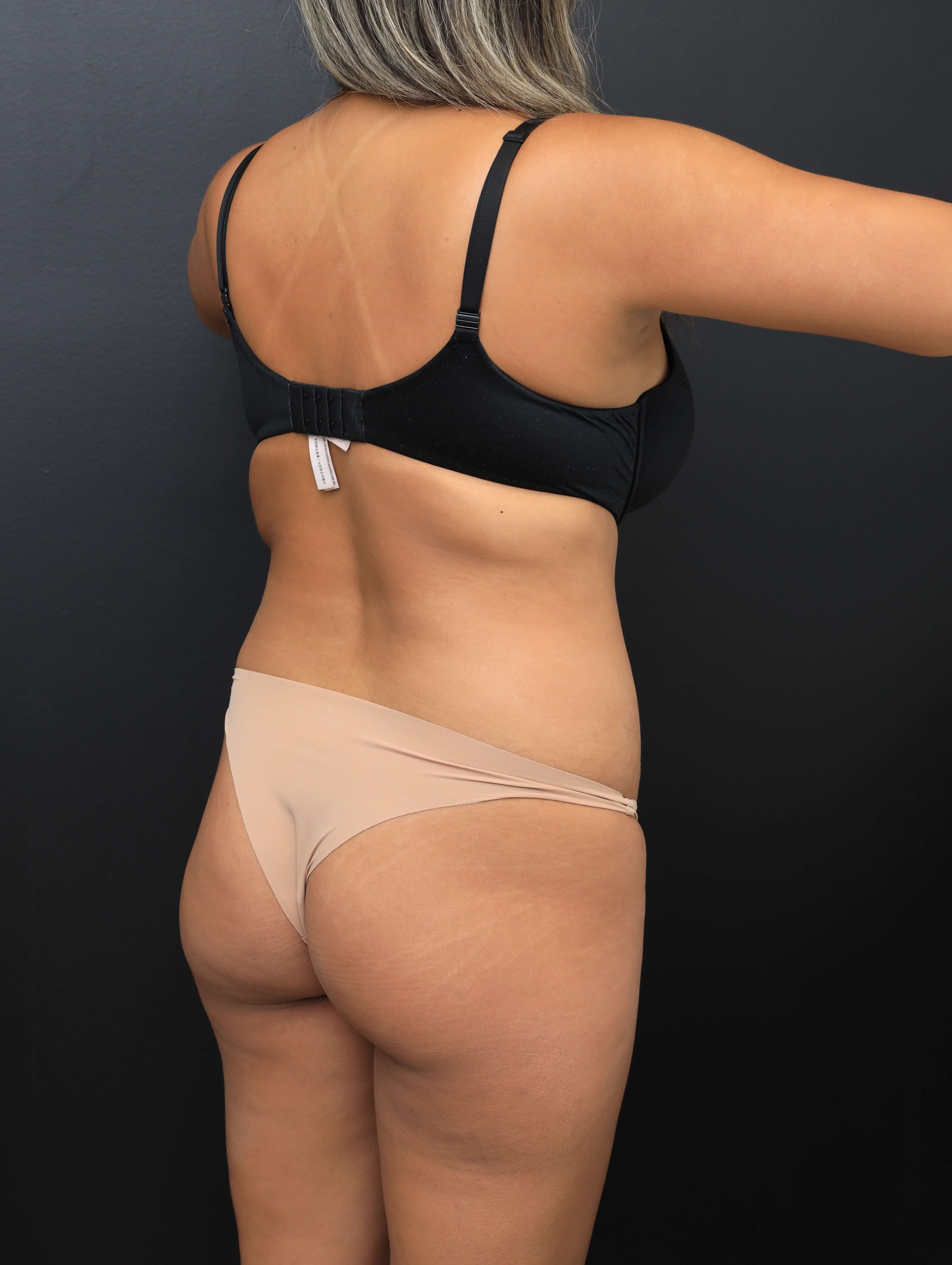 Right Posterior Oblique Before