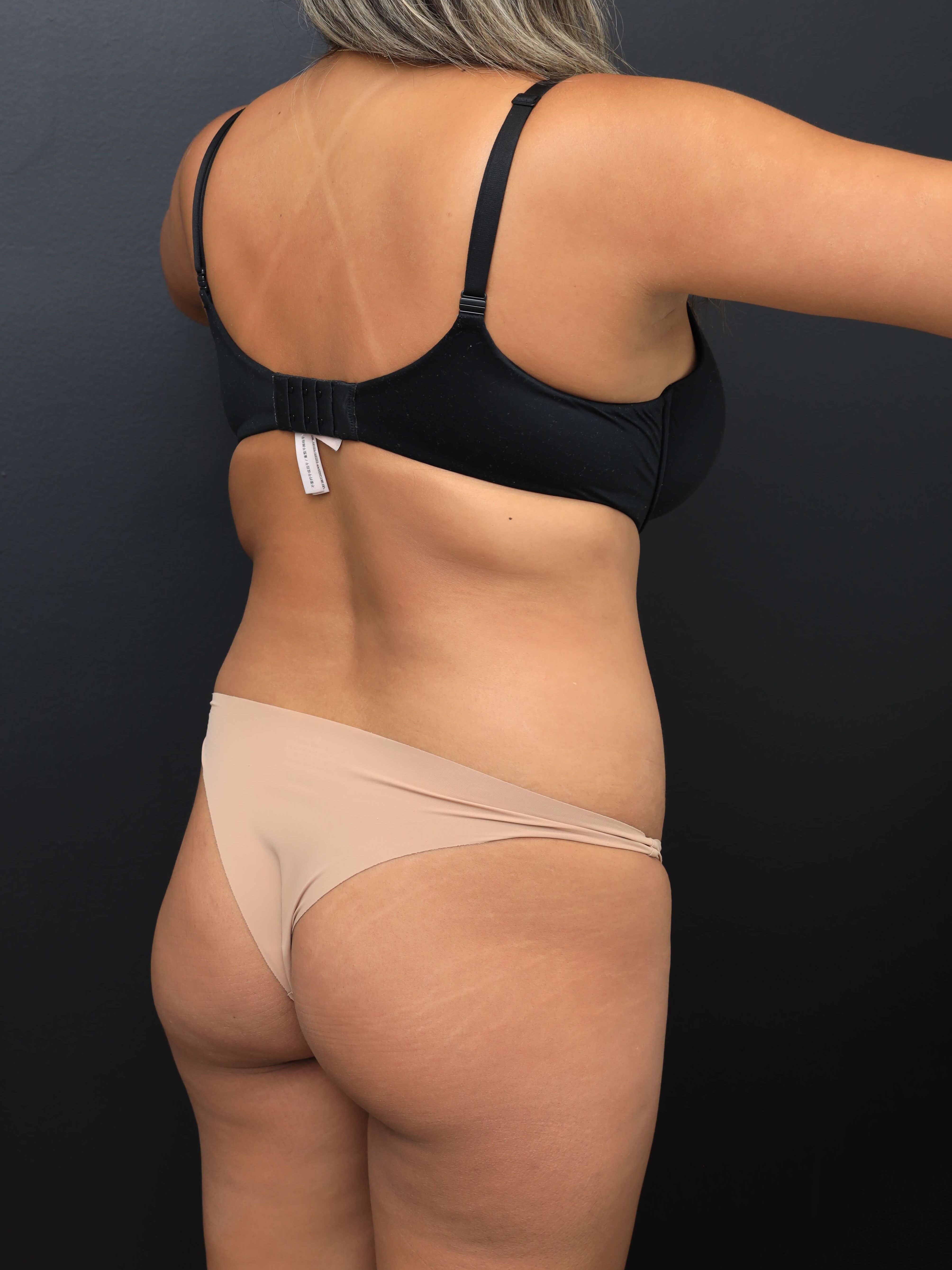Right Posterior Oblique Before