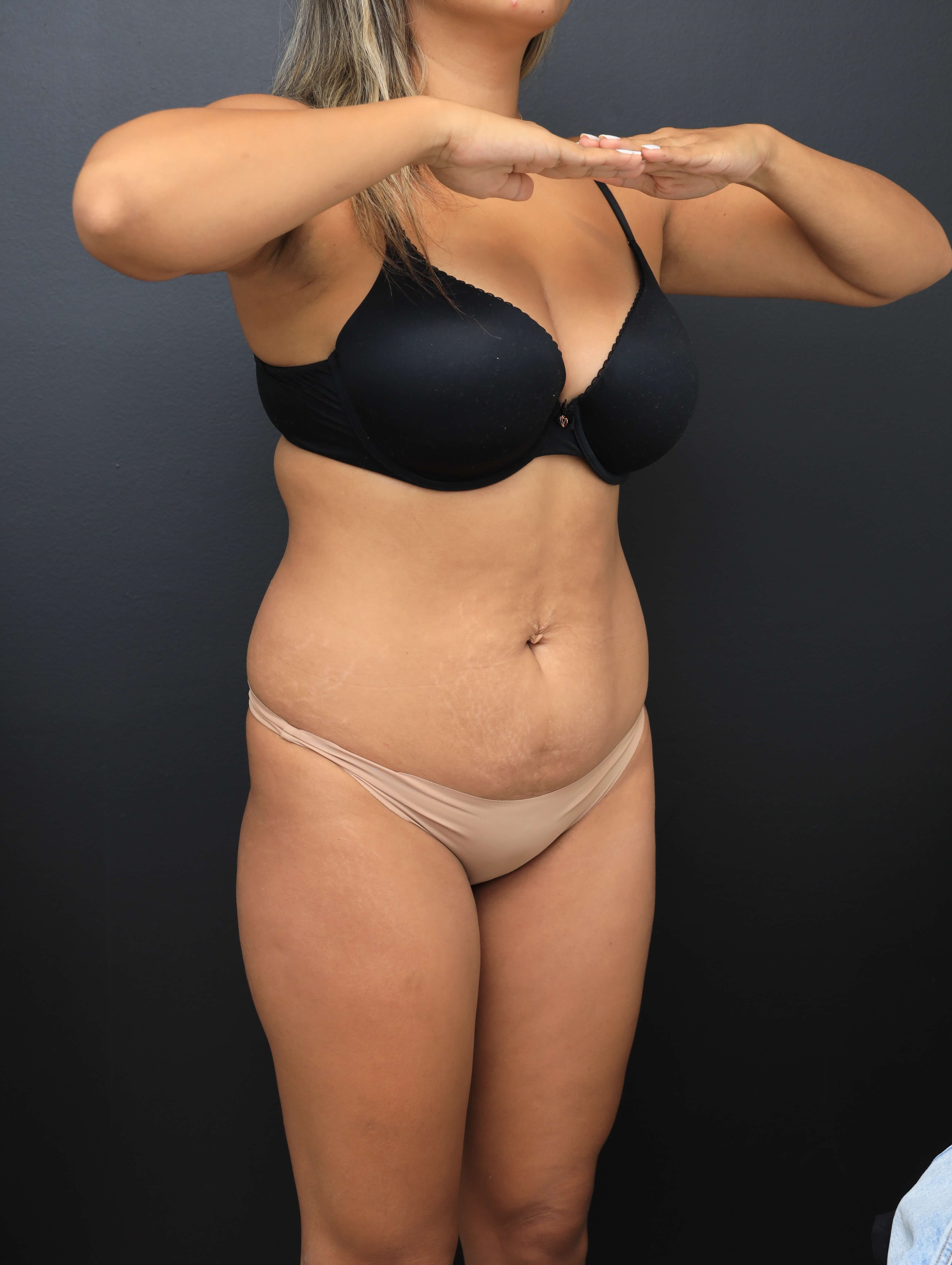 Right Oblique Before