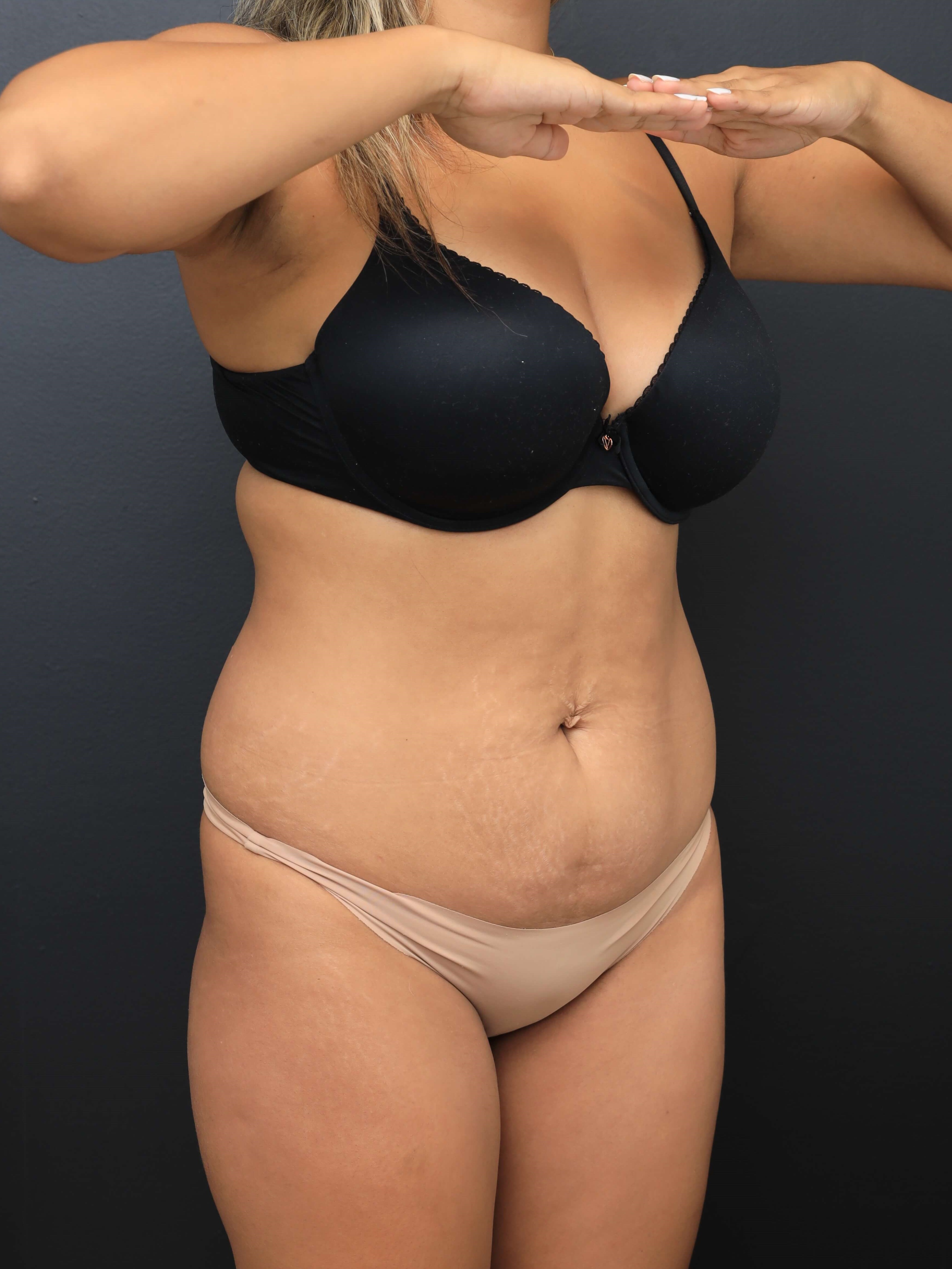 Right Oblique Before