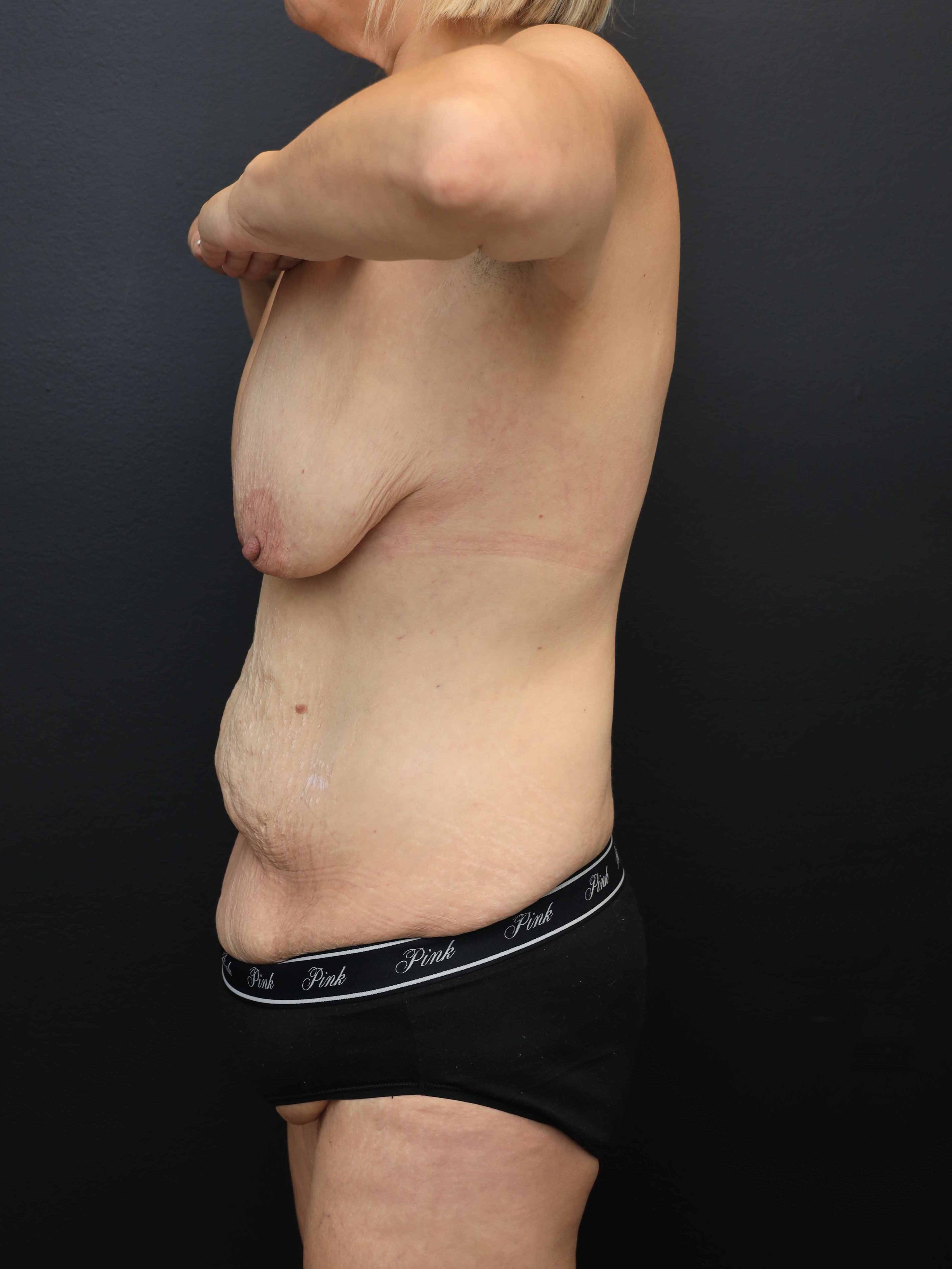 Left Lateral - Arms Up Before